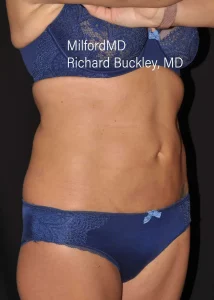 laser-liposuction a4 45R After by MilfordMD in Richard Buckley, MD