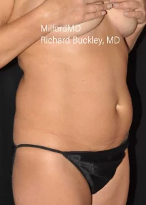 laser-liposuction a4 45R Before by MilfordMD in Richard Buckley, MD