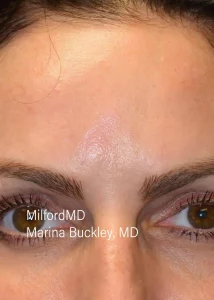 vbeam by MilfordMD in Richard E. Buckley, MD