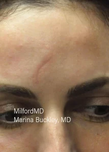 vbeam MilfordMD in Marina Buckley, MD,