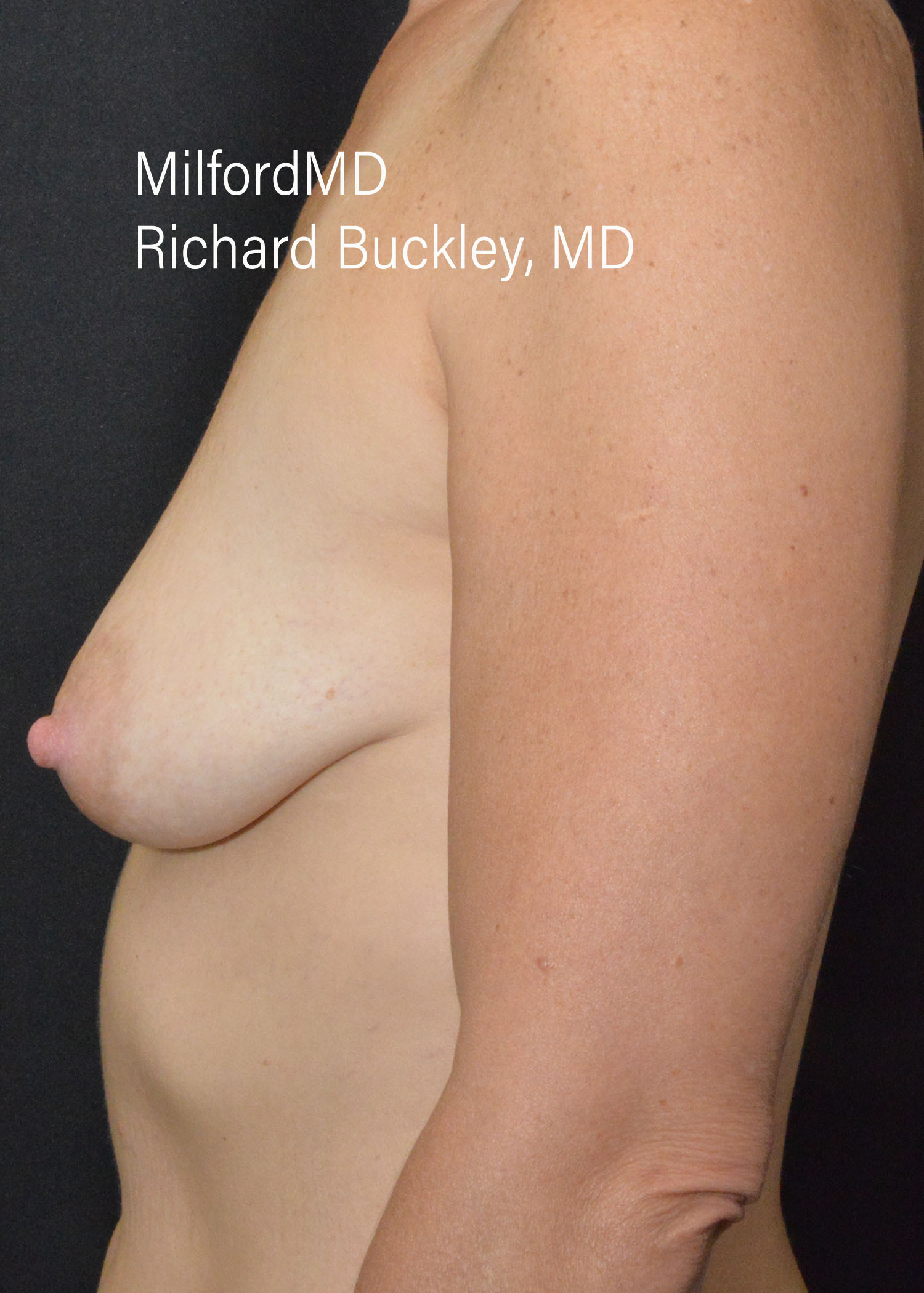 Before: BREAST AUGMENTATION – CASE #35682