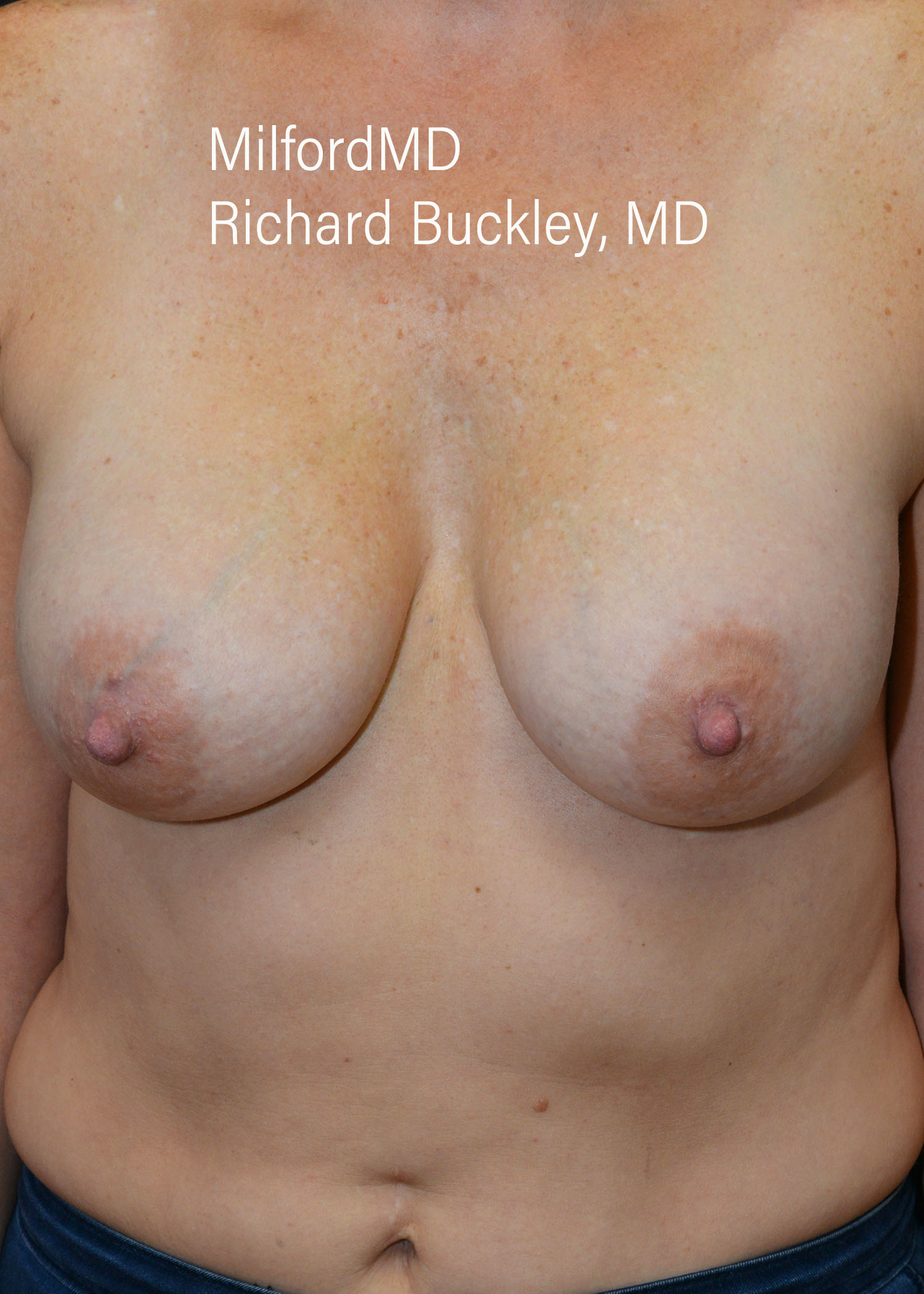 After: BREAST AUGMENTATION – CASE #35682