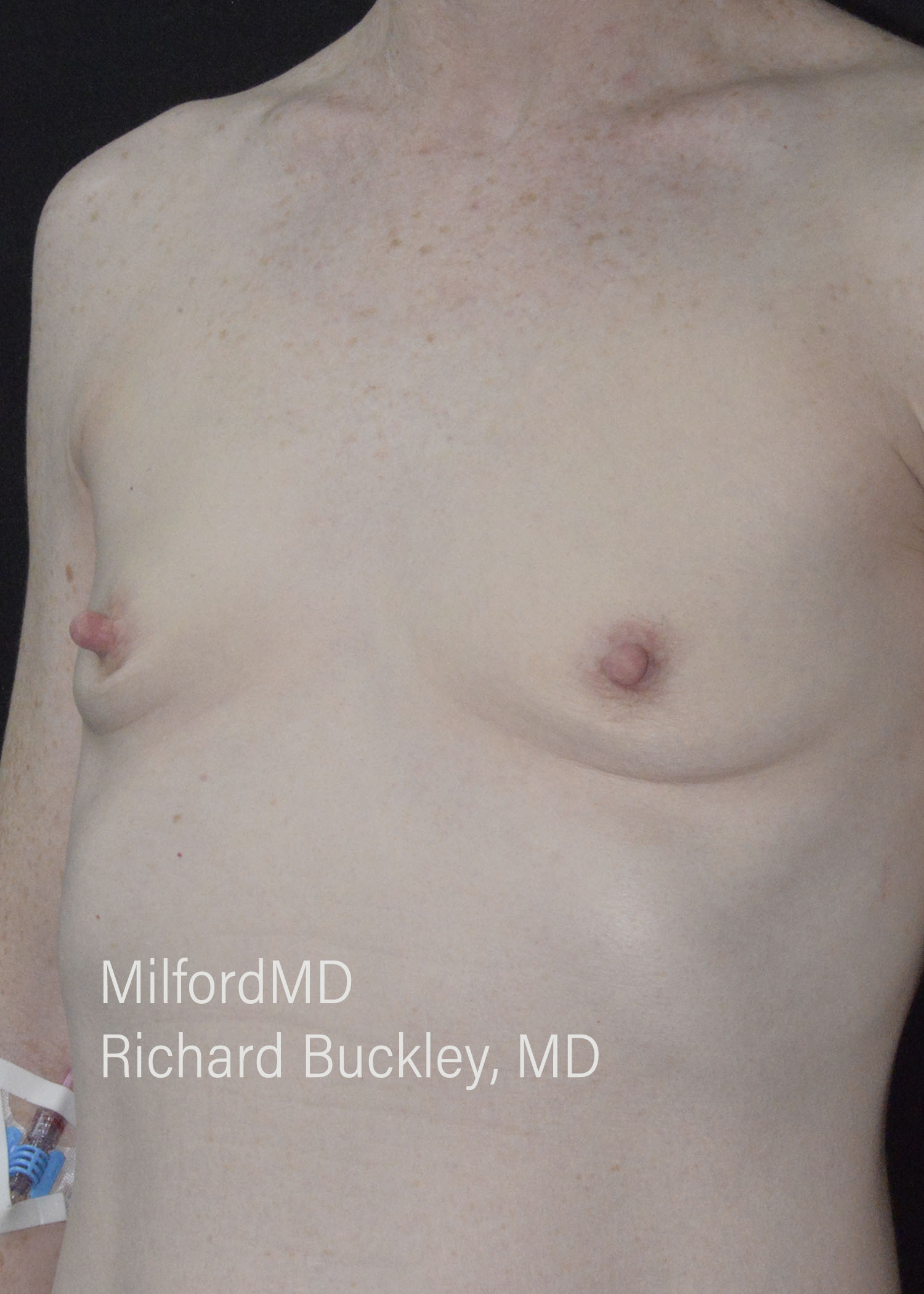 Before: BREAST AUGMENTATION – CASE #52208