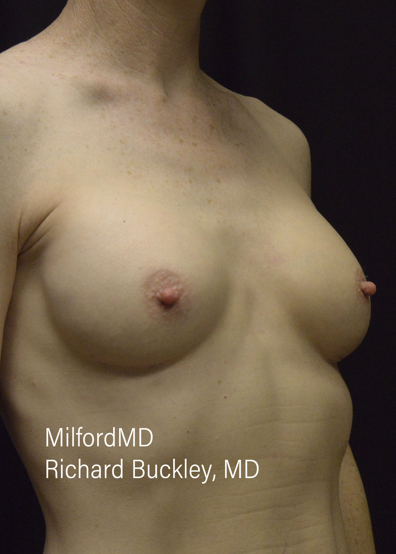 After: BREAST AUGMENTATION – CASE #52208