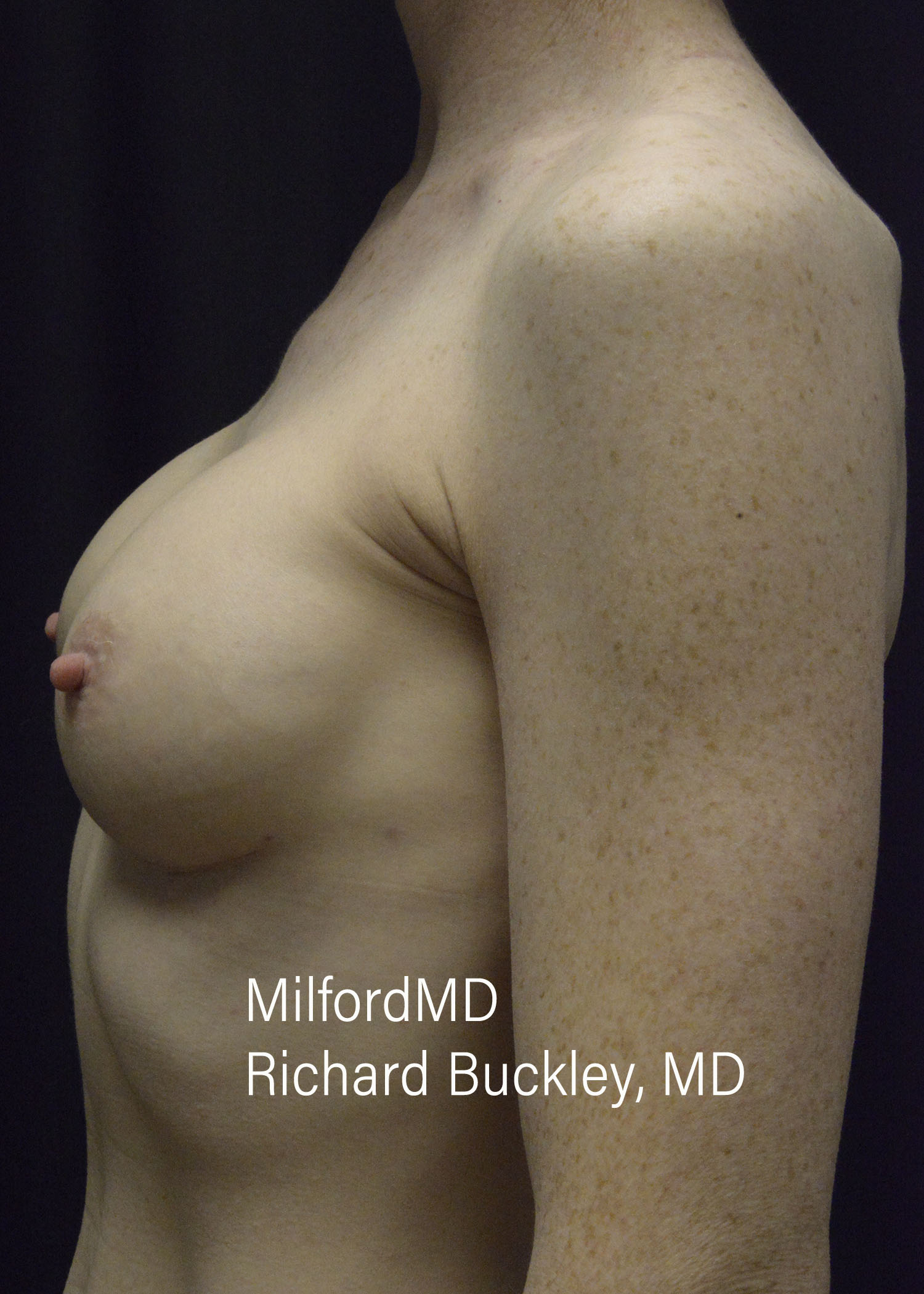 After: BREAST AUGMENTATION – CASE #52208
