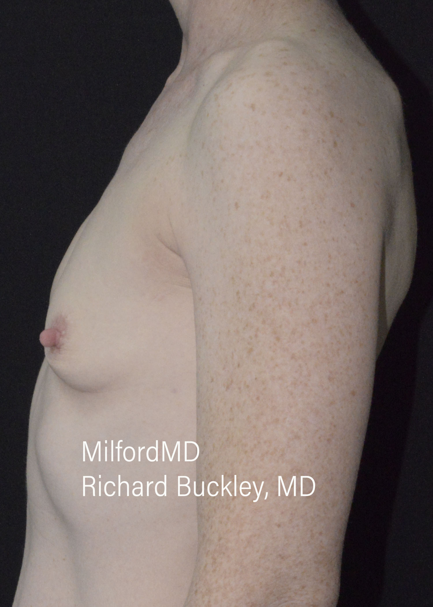 Before: BREAST AUGMENTATION – CASE #52208