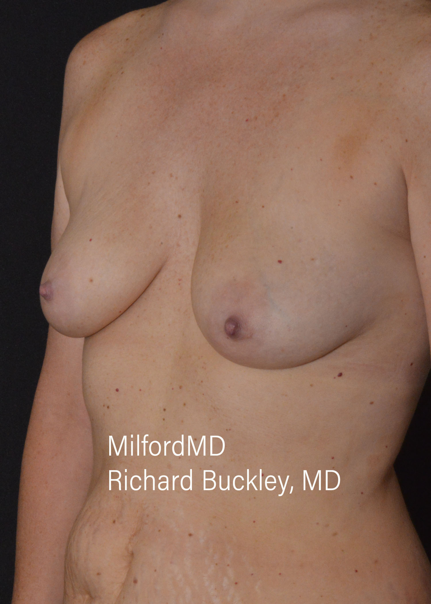 Before: BREAST AUGMENTATION – CASE #35658