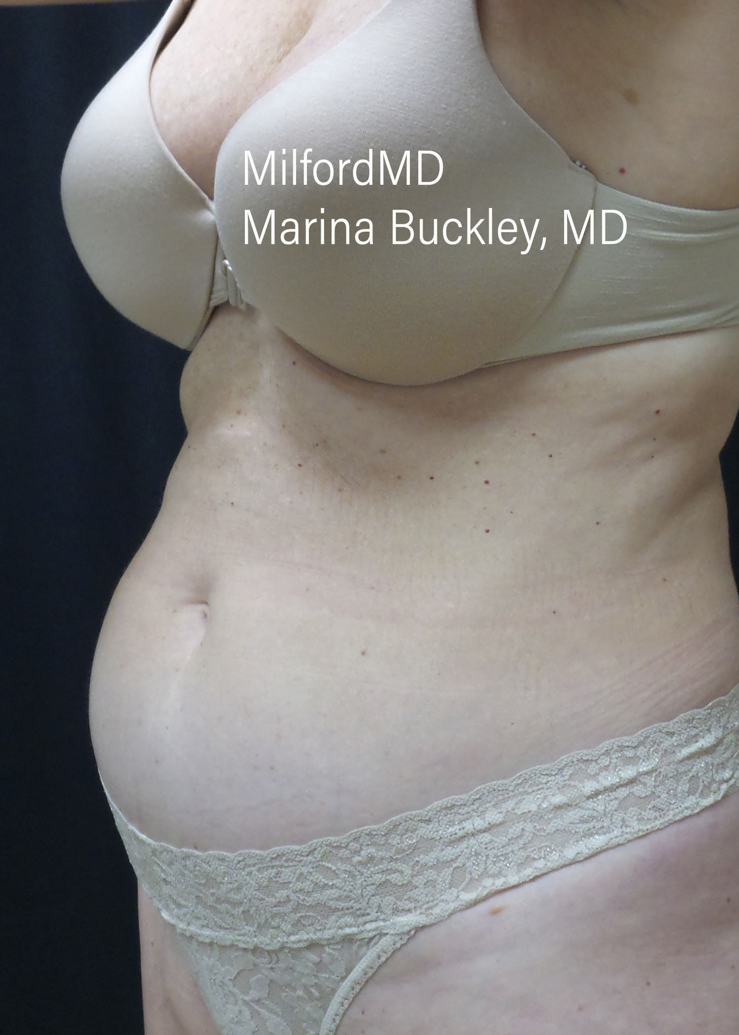 Before: BREAST AUGMENTATION – CASE #52207