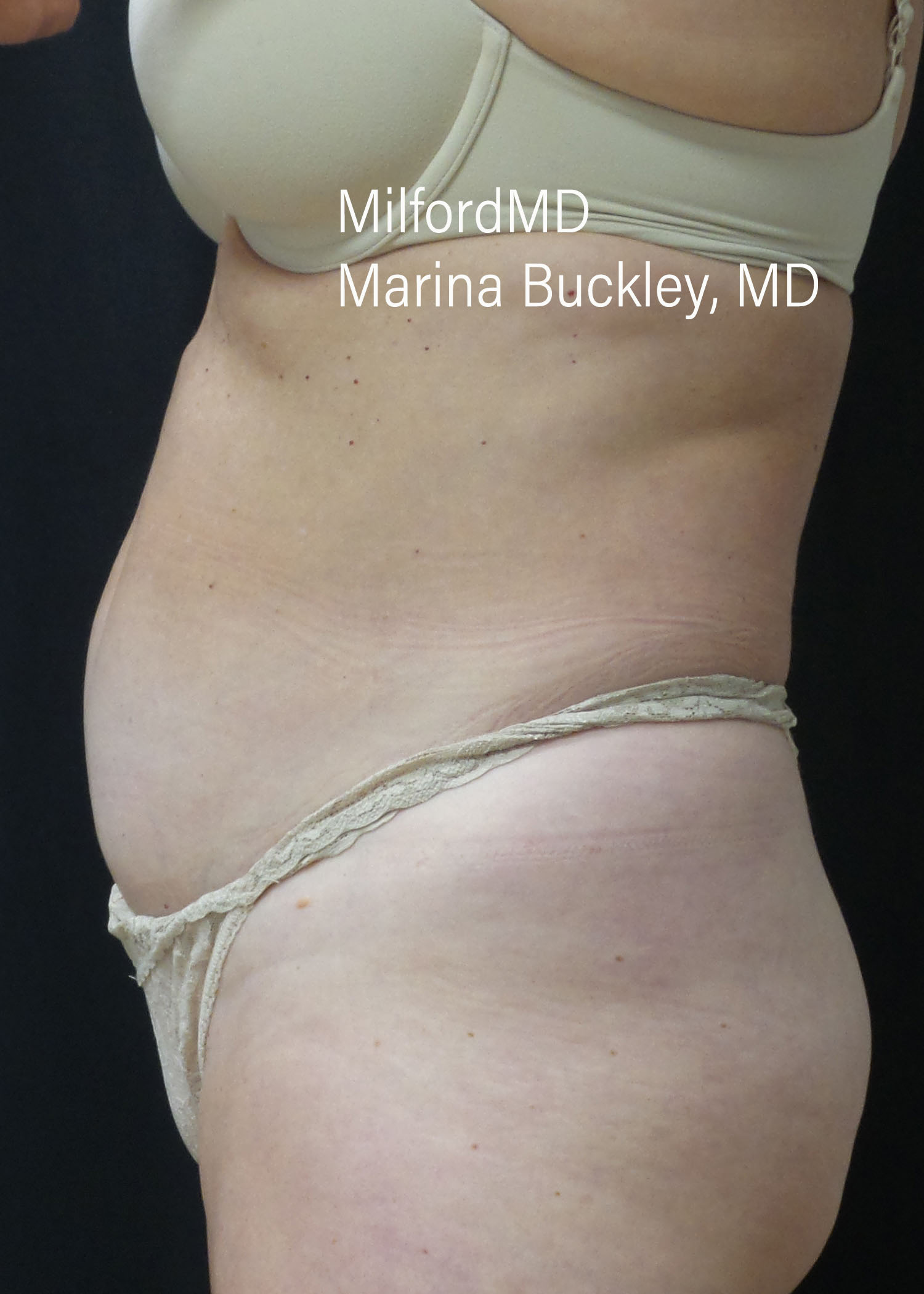 Before: BREAST AUGMENTATION – CASE #52207