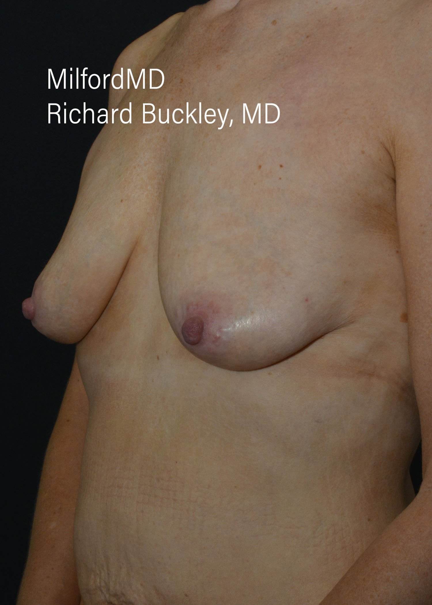 Before: BREAST AUGMENTATION – CASE #52209