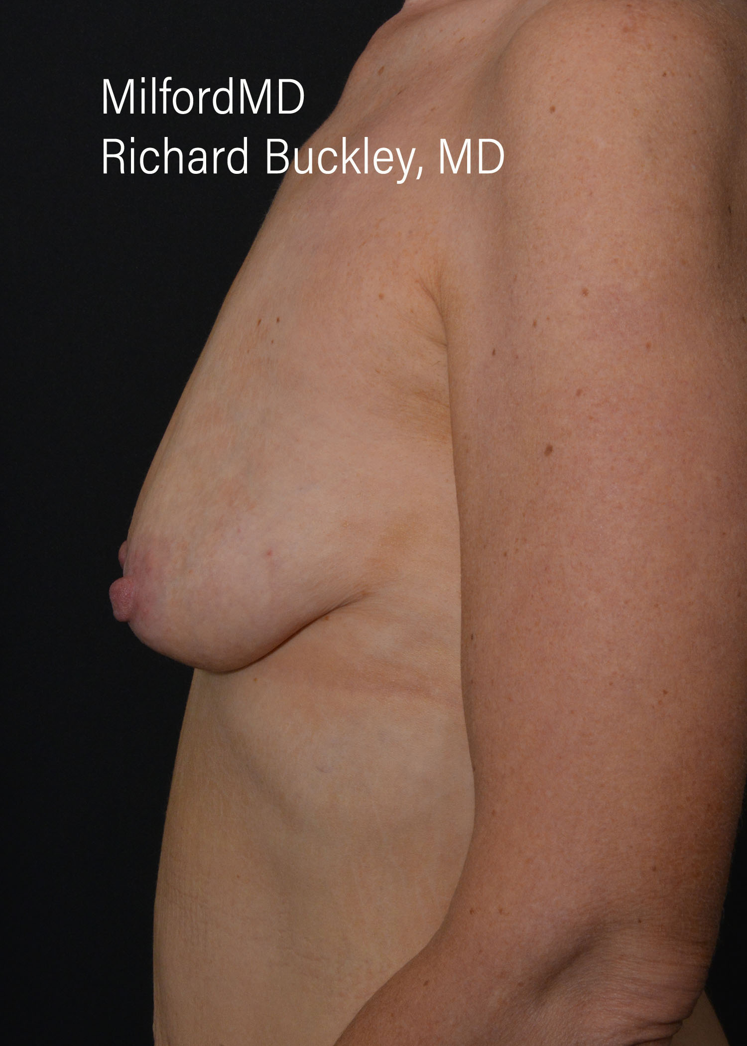 Before: BREAST AUGMENTATION – CASE #52209