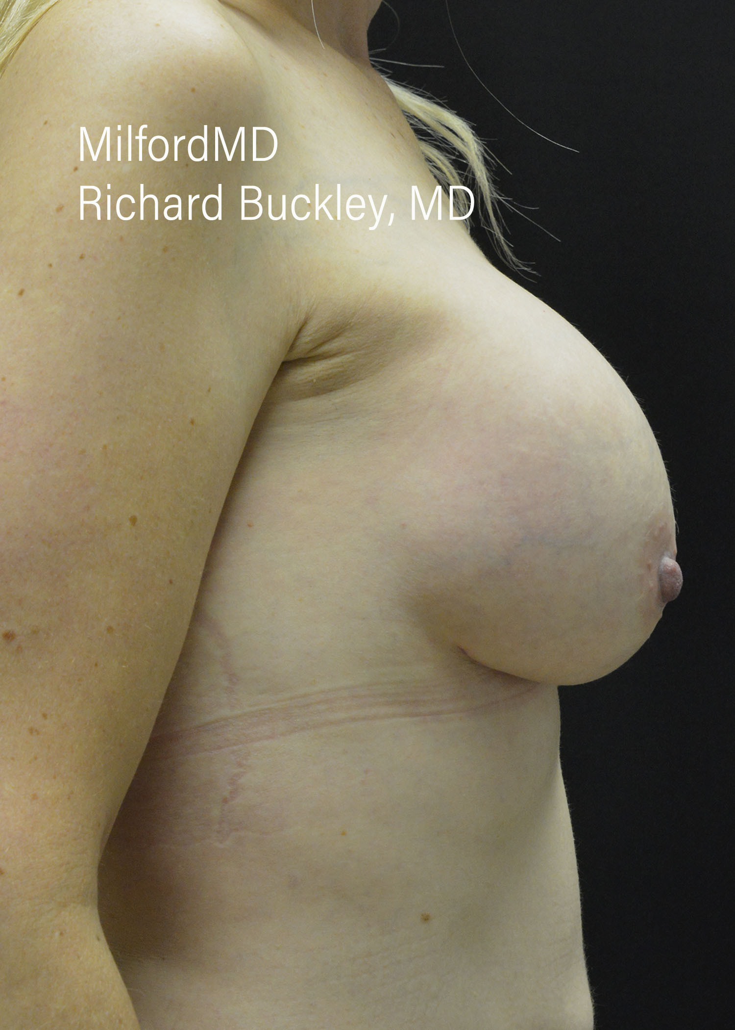 After: BREAST AUGMENTATION – CASE #52209