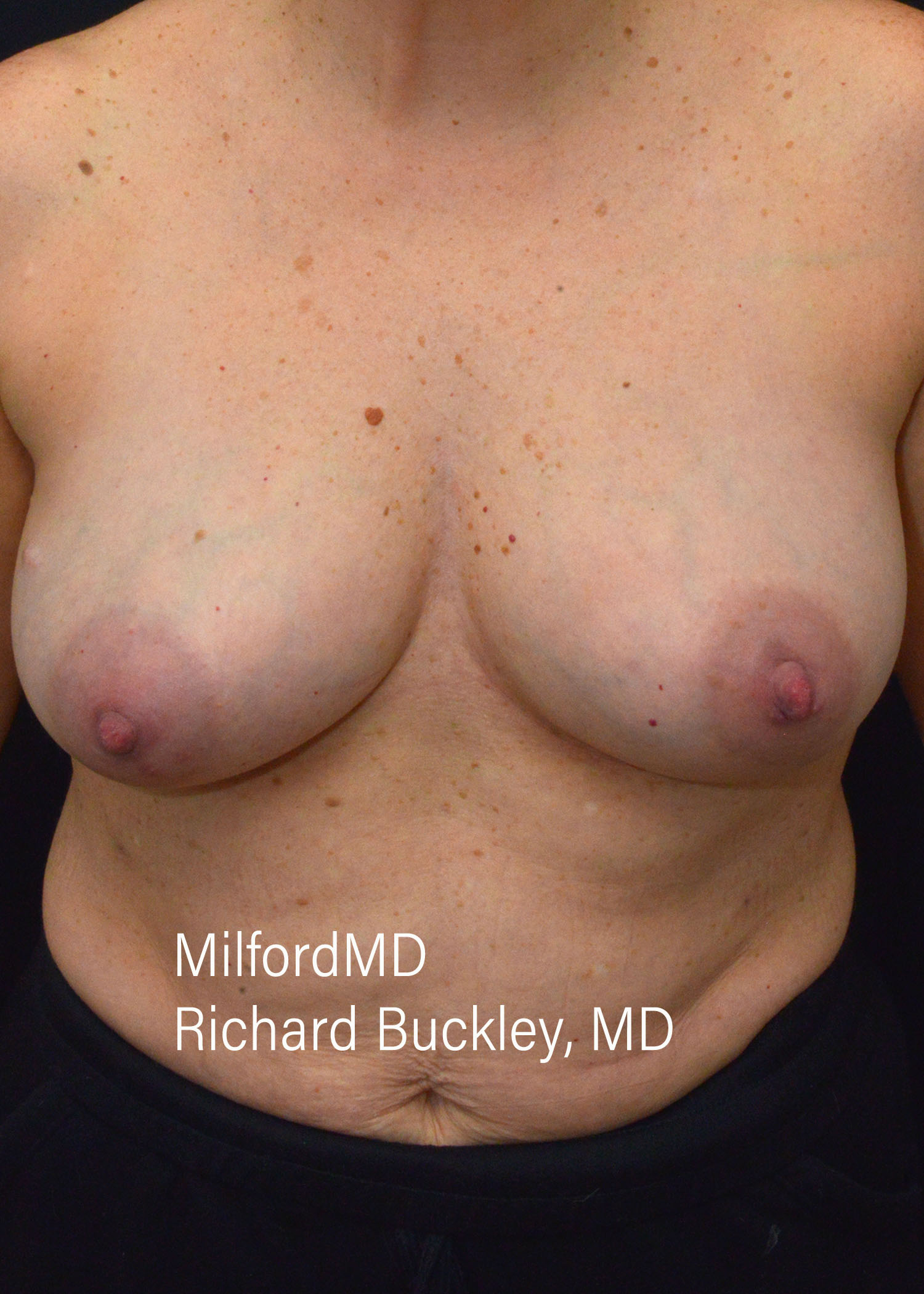 Breast Augmentation Before and After Photos,Breast Augmentation Before and After,Breast Augmentation Before & After Photos,Before and After Breast Augmentation,Breast Augmentation Before & After Gallery, Breast Augmentation