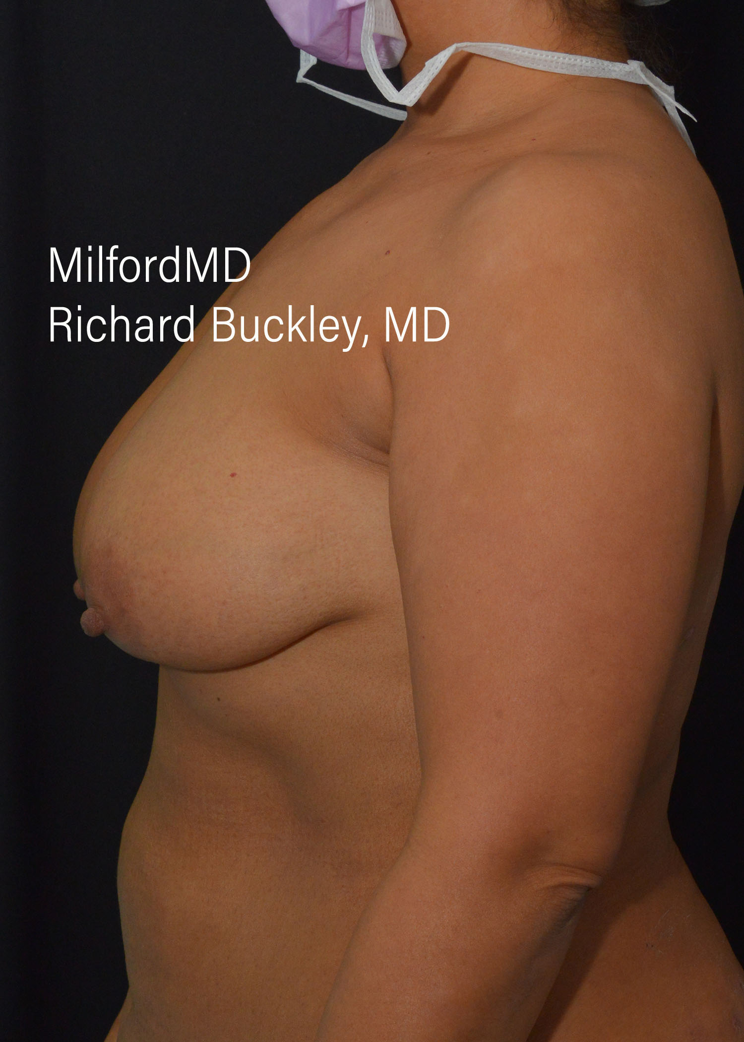 Before: BREAST AUGMENTATION AFT – CASE #52207