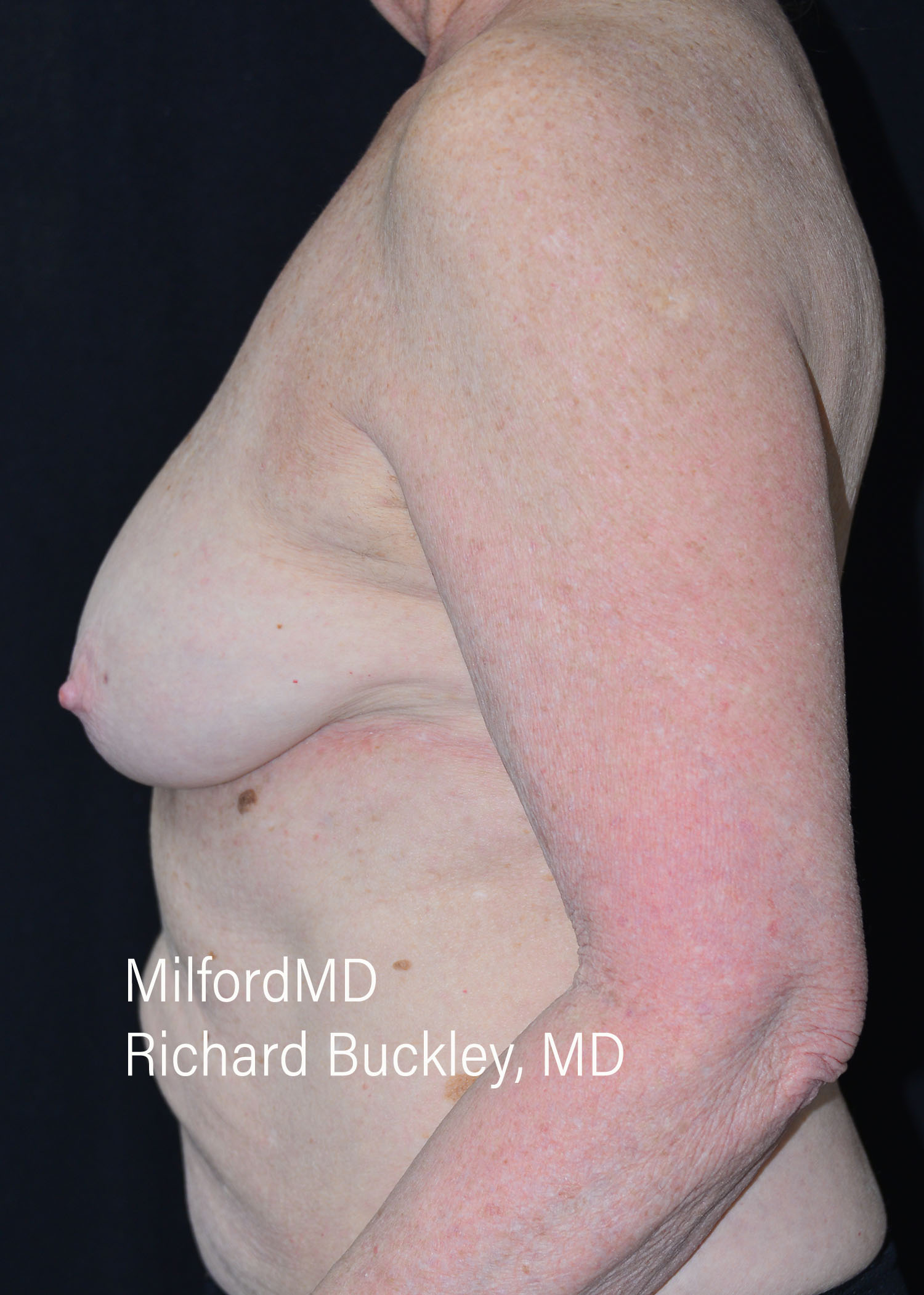 After: BREAST AUGMENTATION – CASE #62522