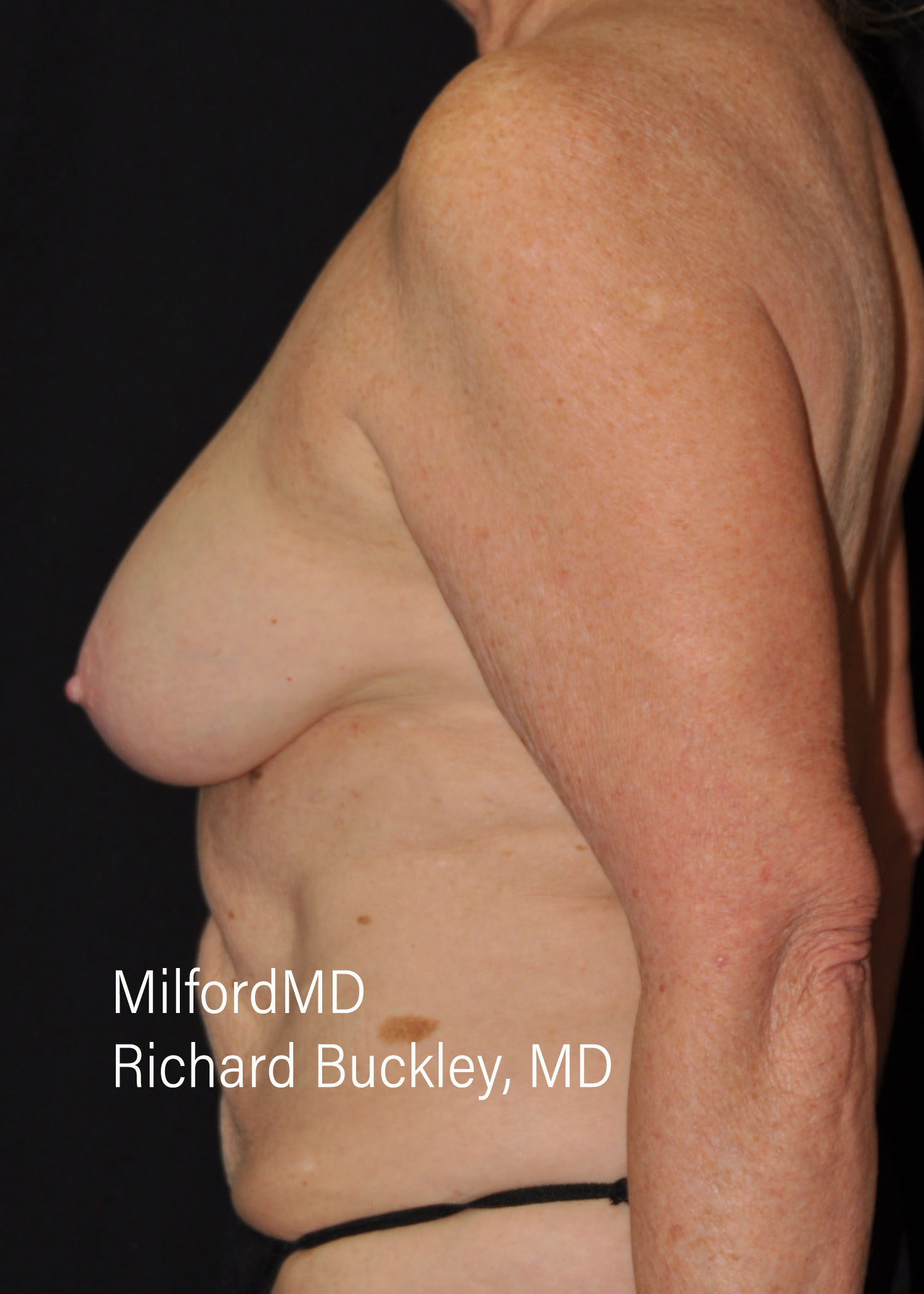 Before: BREAST AUGMENTATION – CASE #62522