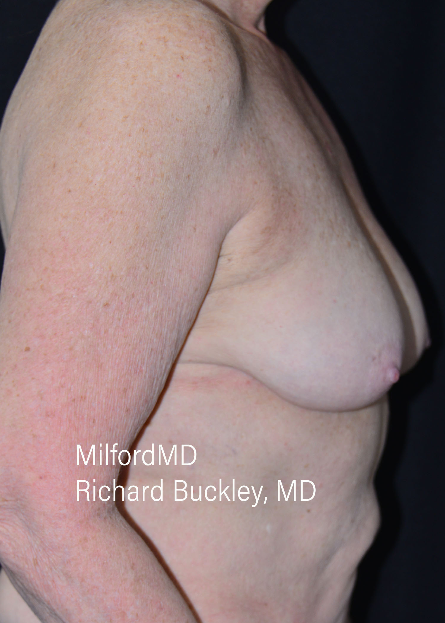 After: BREAST AUGMENTATION – CASE #62522