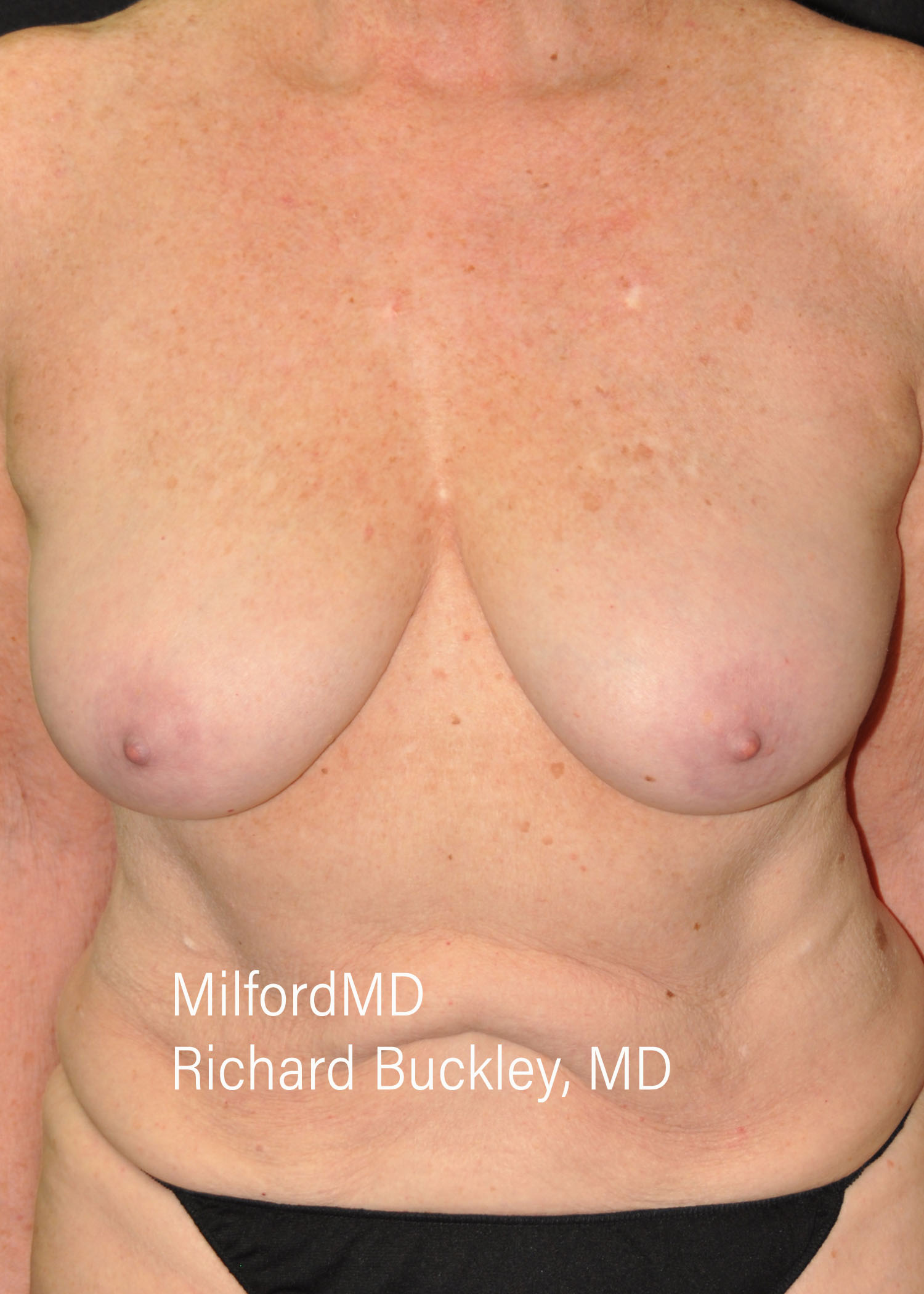 Breast Reduction Before and After,Breast Reduction Before and After Photos,Breast Reduction, Breast Reduction