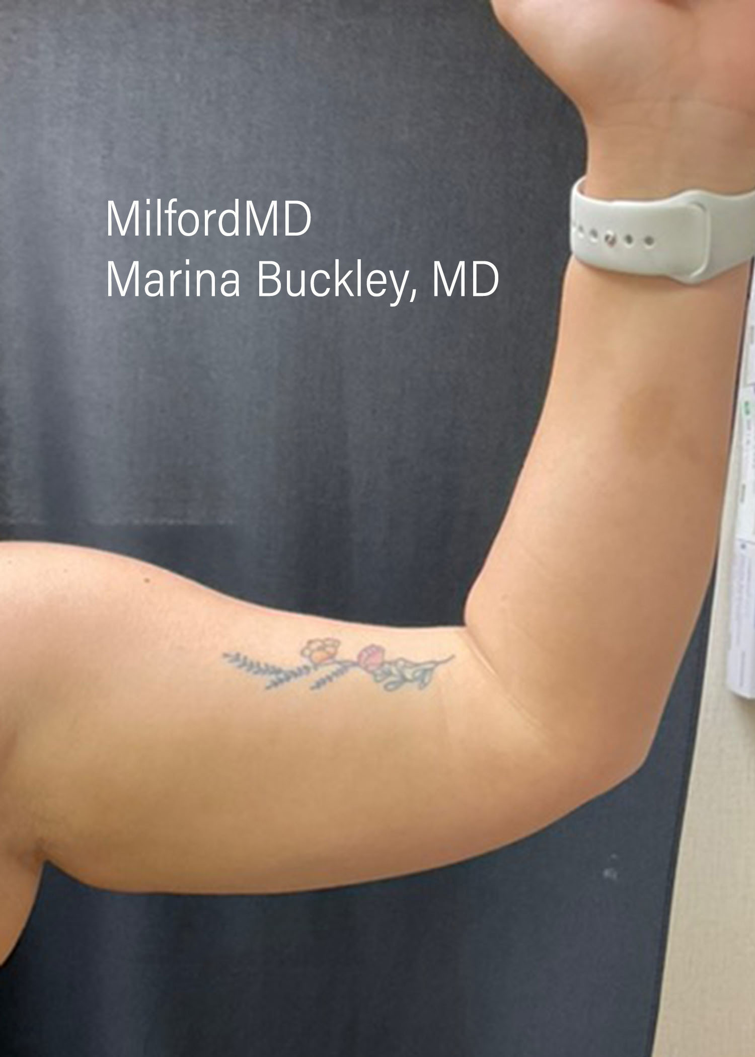 After: Coolsculpting Arm Treatments – Case #52401