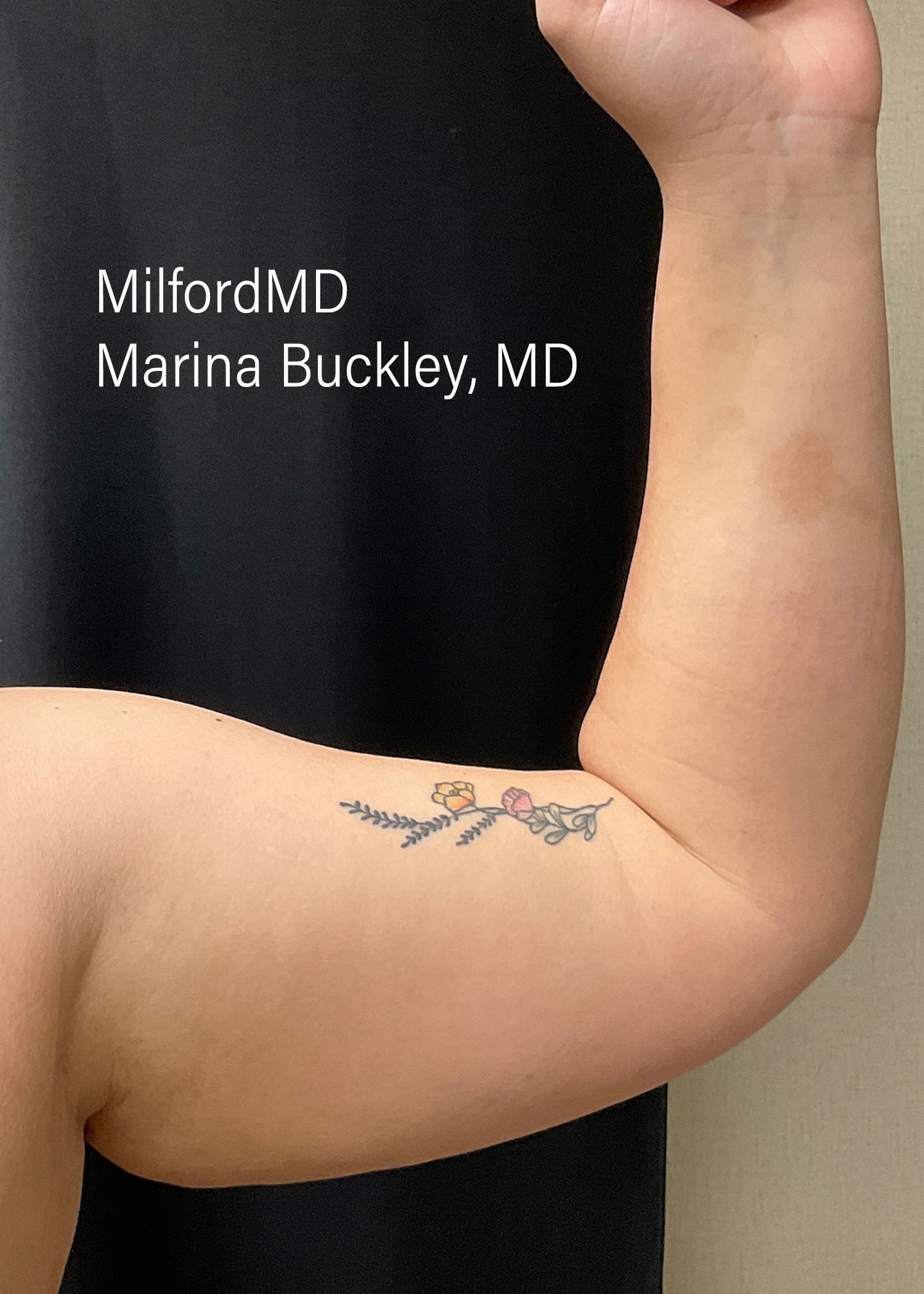 Before: Coolsculpting Arm Treatments – Case #52401