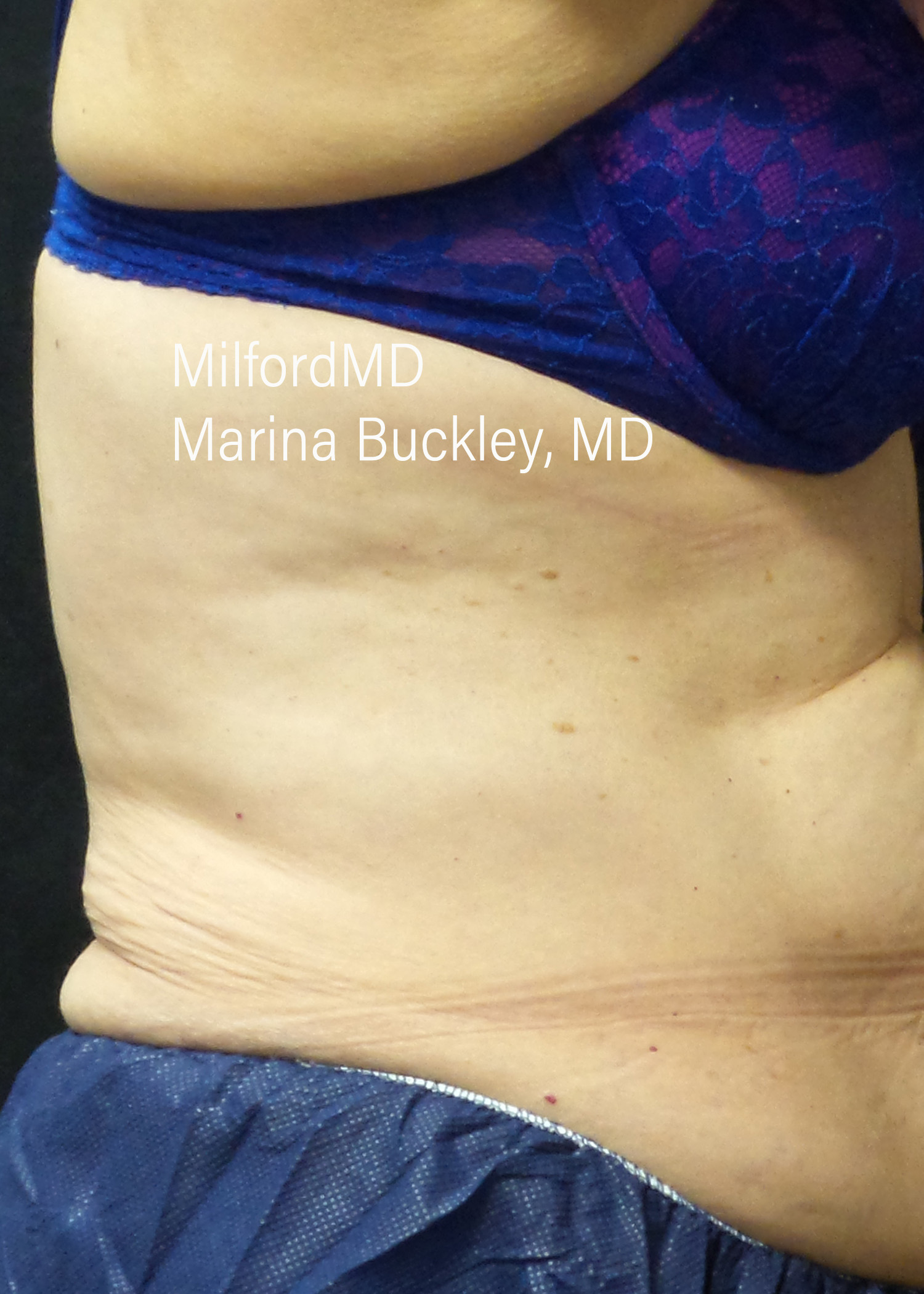 After: CoolSculpting® Love Handles – Case #36121