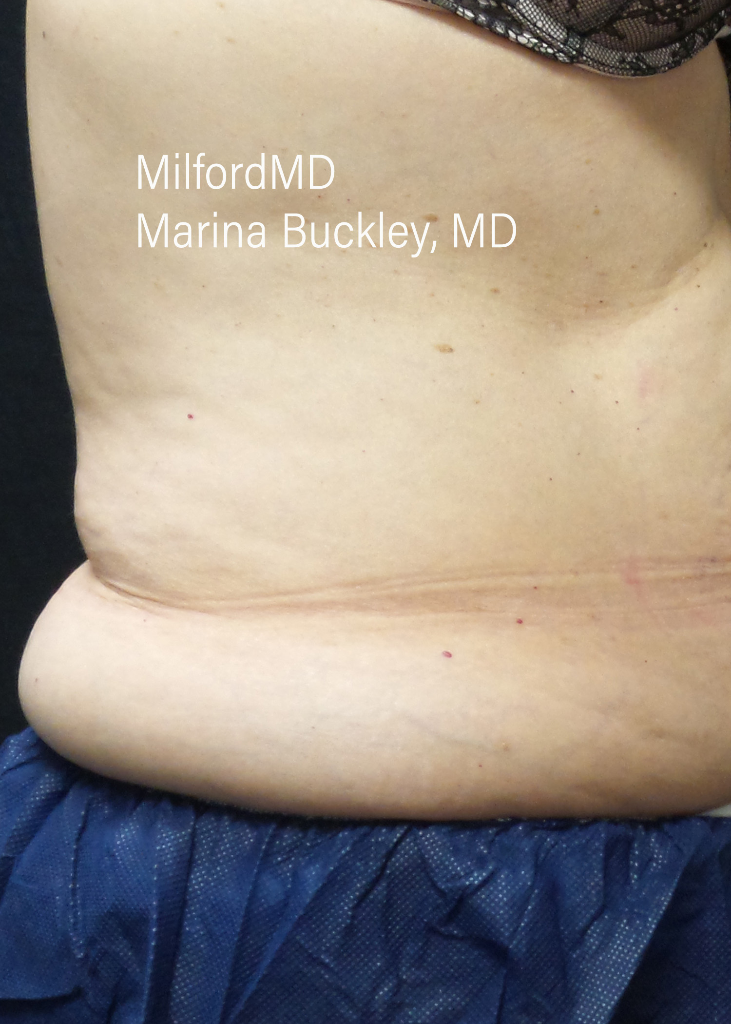 Before: CoolSculpting® Love Handles – Case #36121