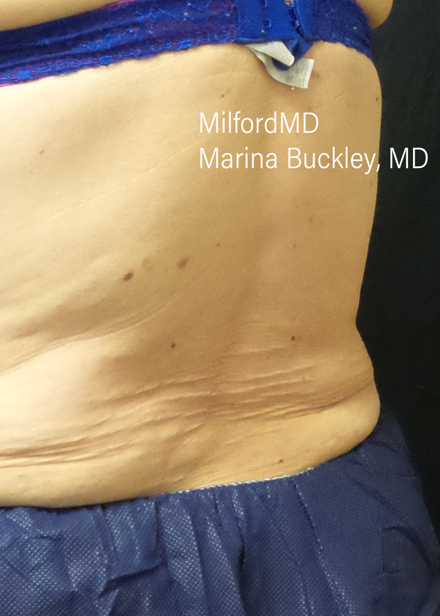 After: CoolSculpting® Love Handles – Case #36121