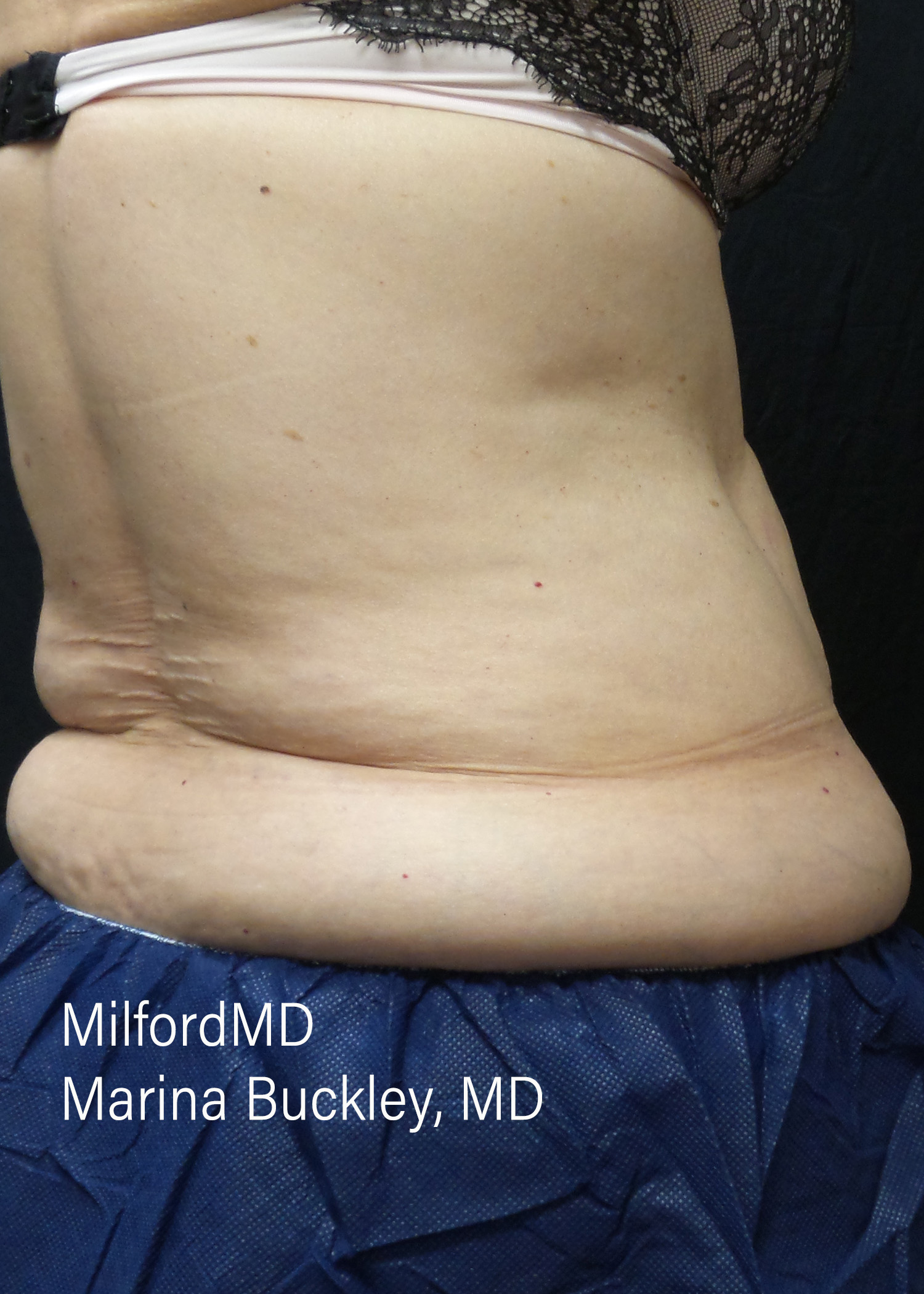 Before: CoolSculpting® Love Handles – Case #36121