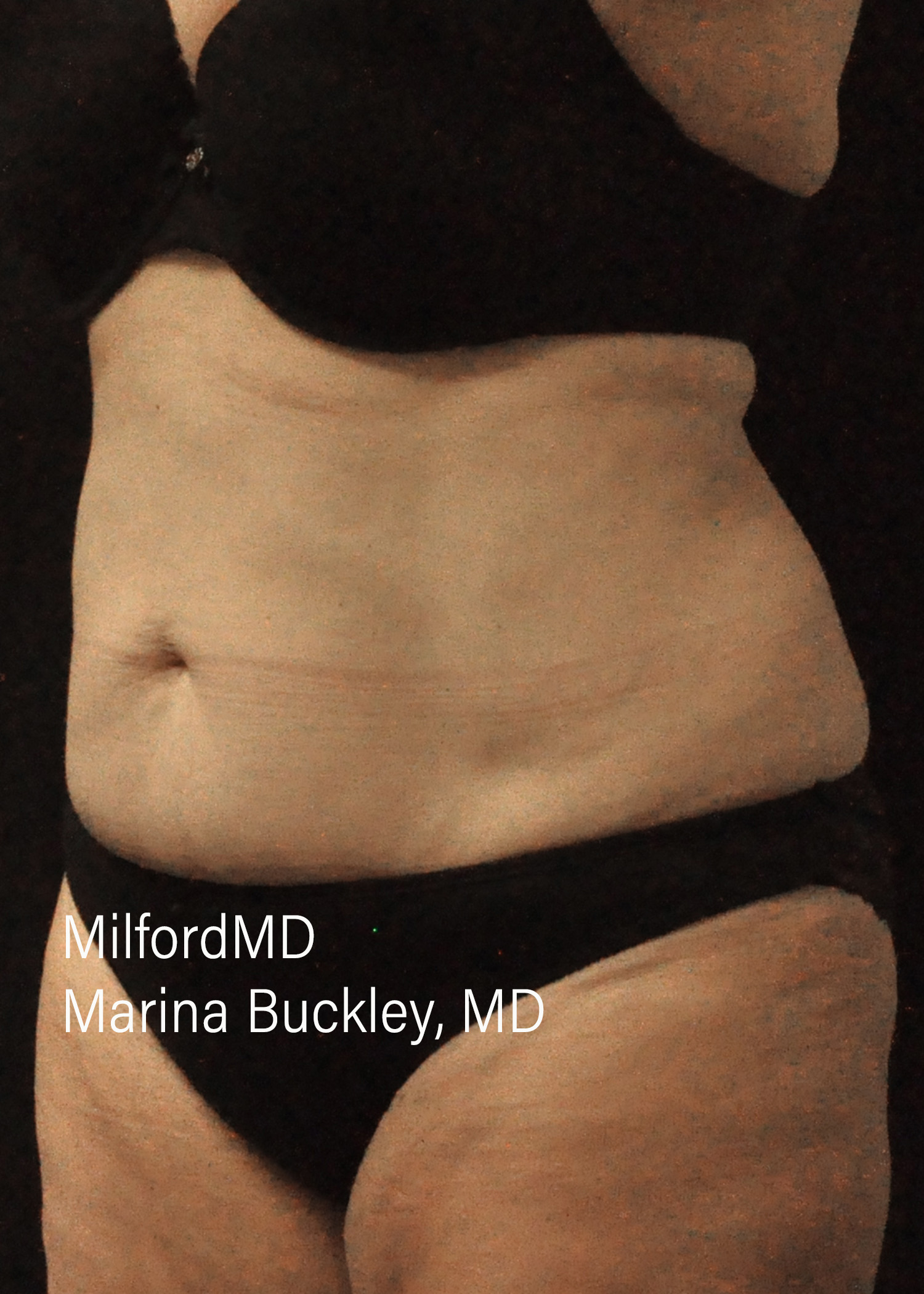 After: CoolSculpting® Body Treatments Using CoolSculpting® Abdomen – Case #36119