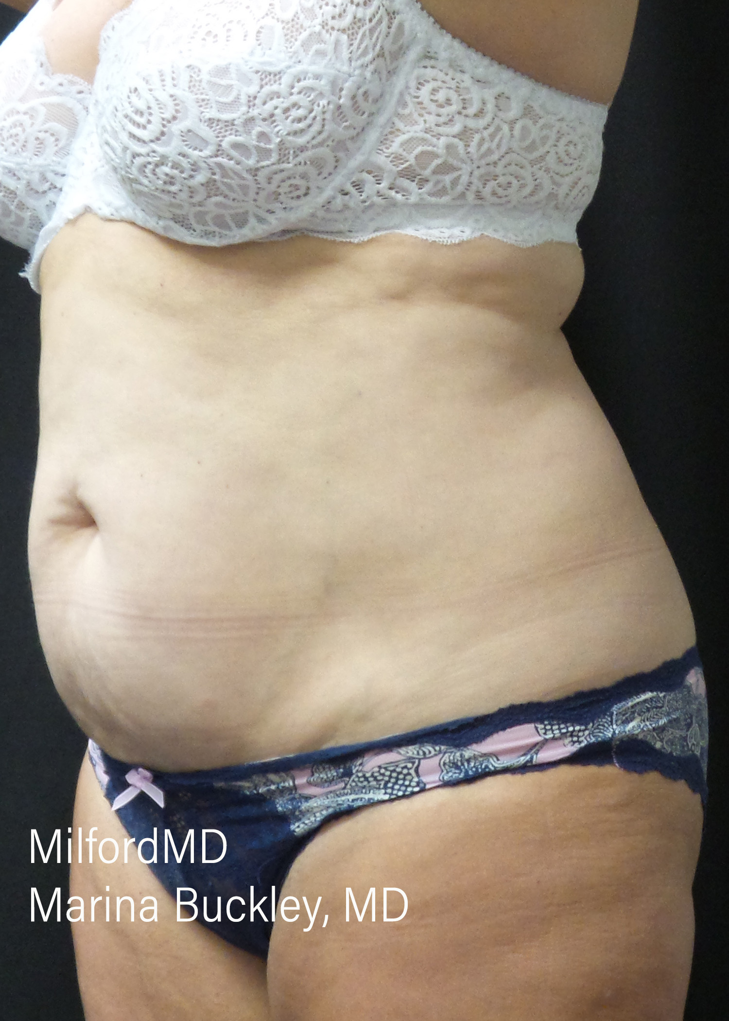 Before: CoolSculpting® Body Treatments Using CoolSculpting® Abdomen – Case #36119