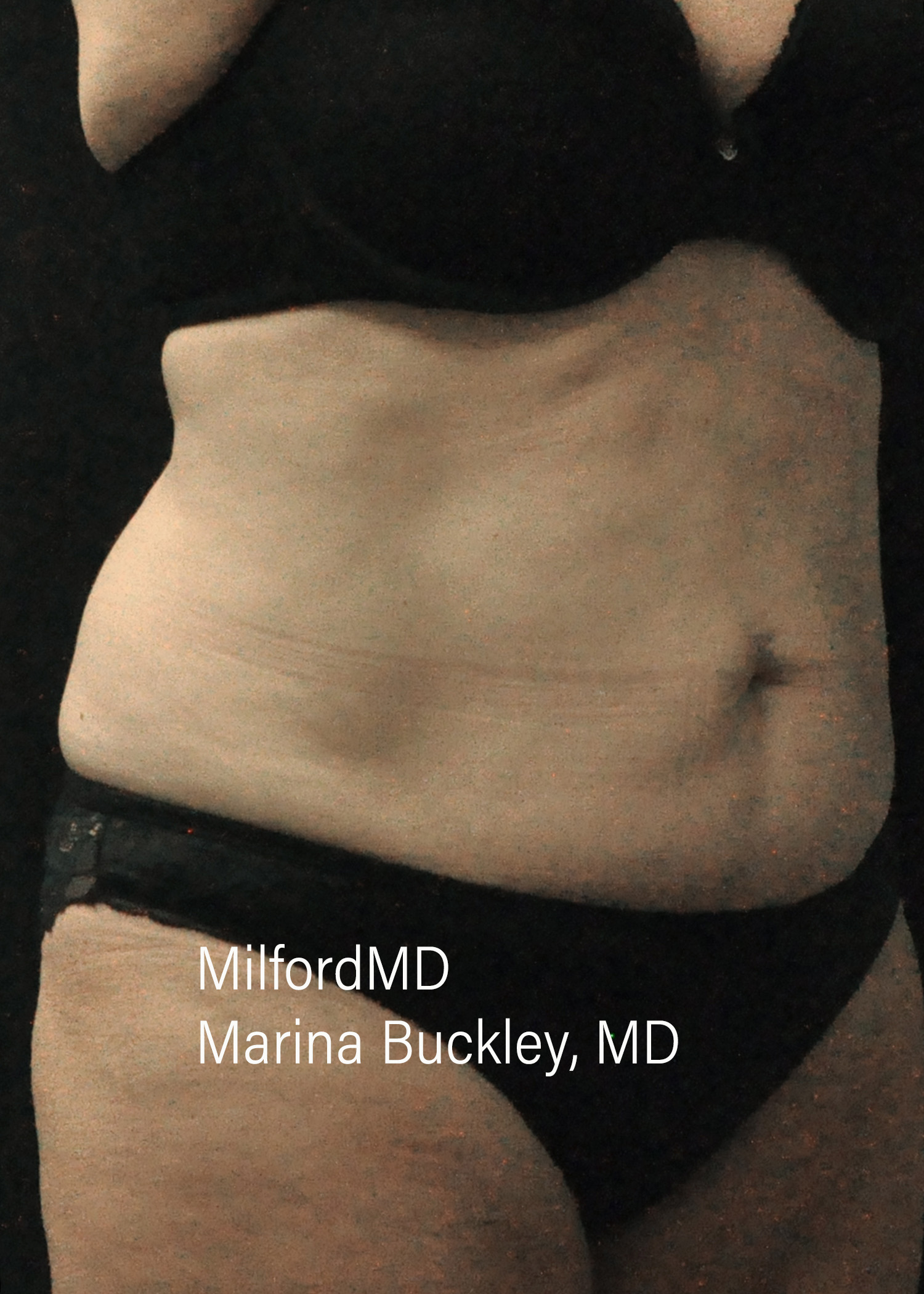 After: CoolSculpting® Body Treatments Using CoolSculpting® Abdomen – Case #36119