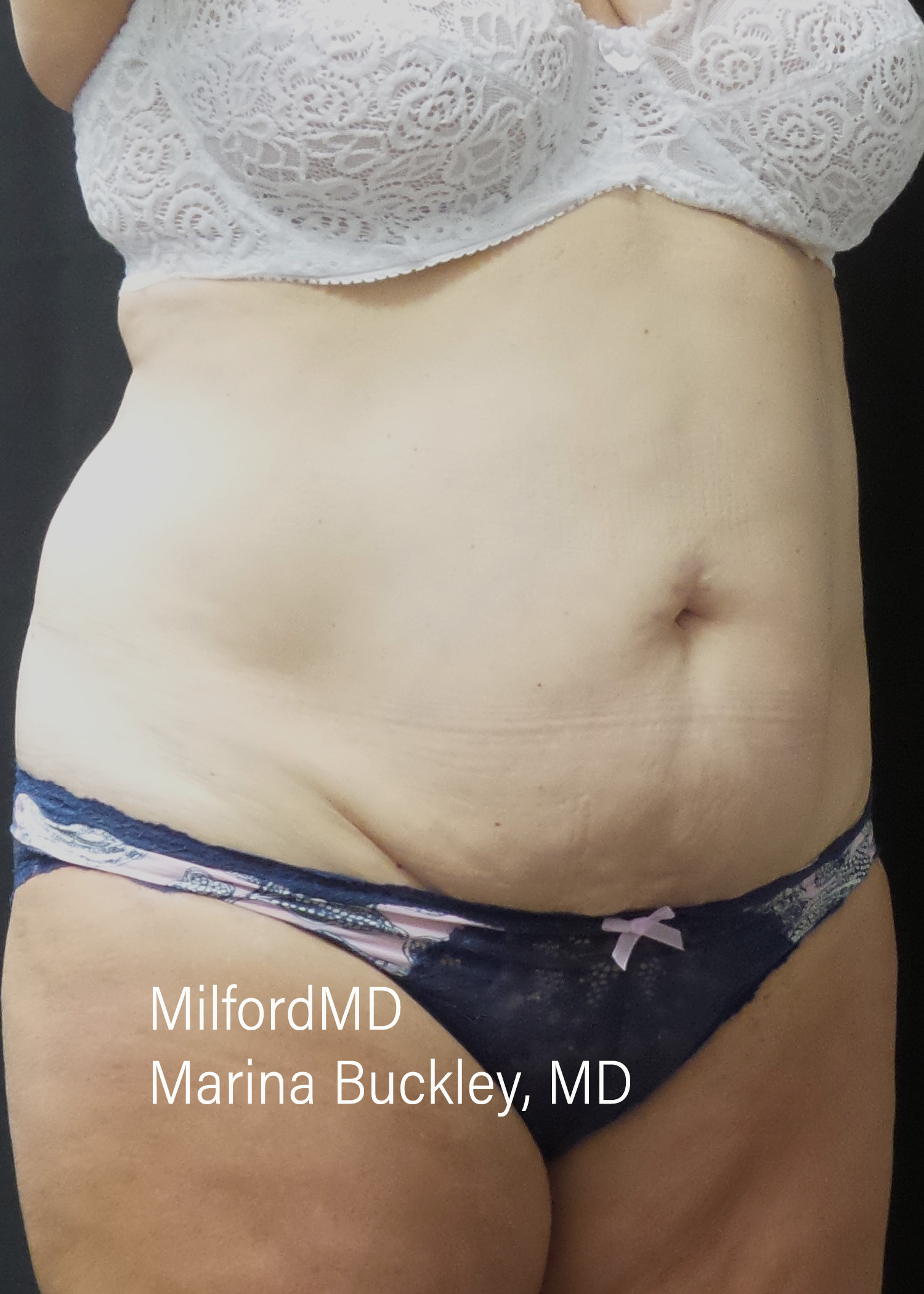 Before: CoolSculpting® Body Treatments Using CoolSculpting® Abdomen – Case #36119