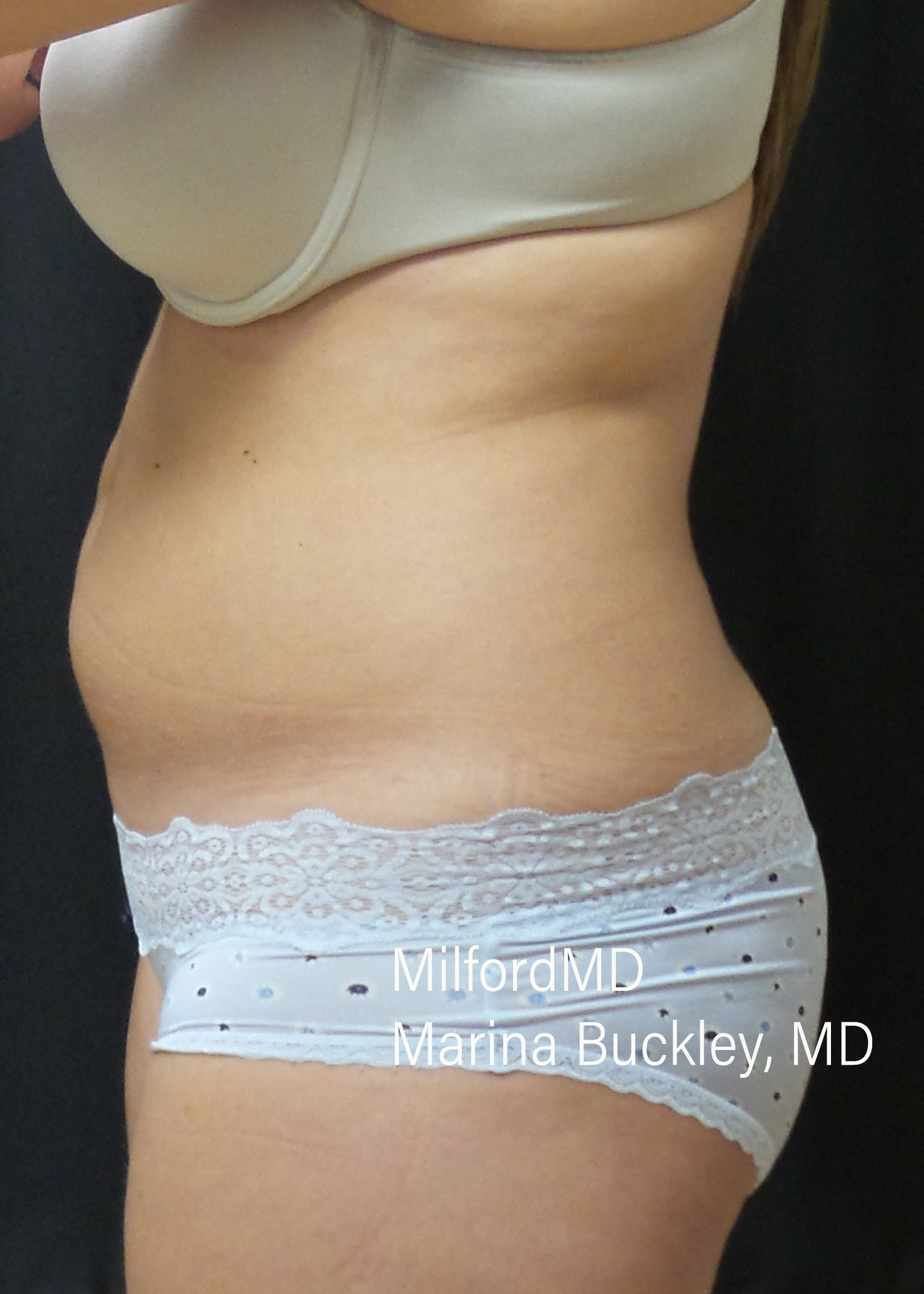 After: CoolSculpting® Love Handles – Case #36122