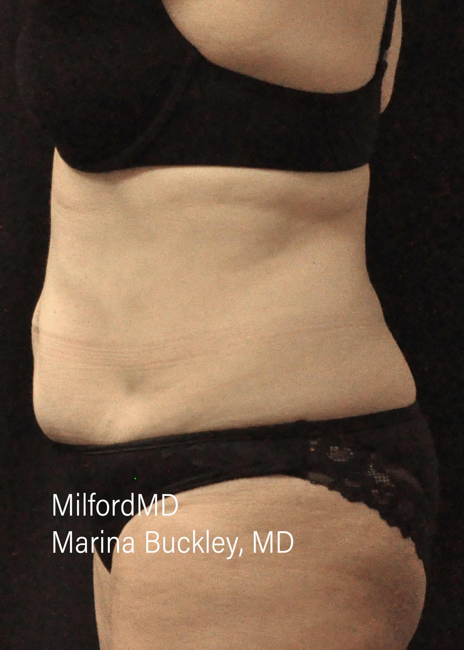 After: CoolSculpting® Body Treatments Using CoolSculpting® Abdomen – Case #36119