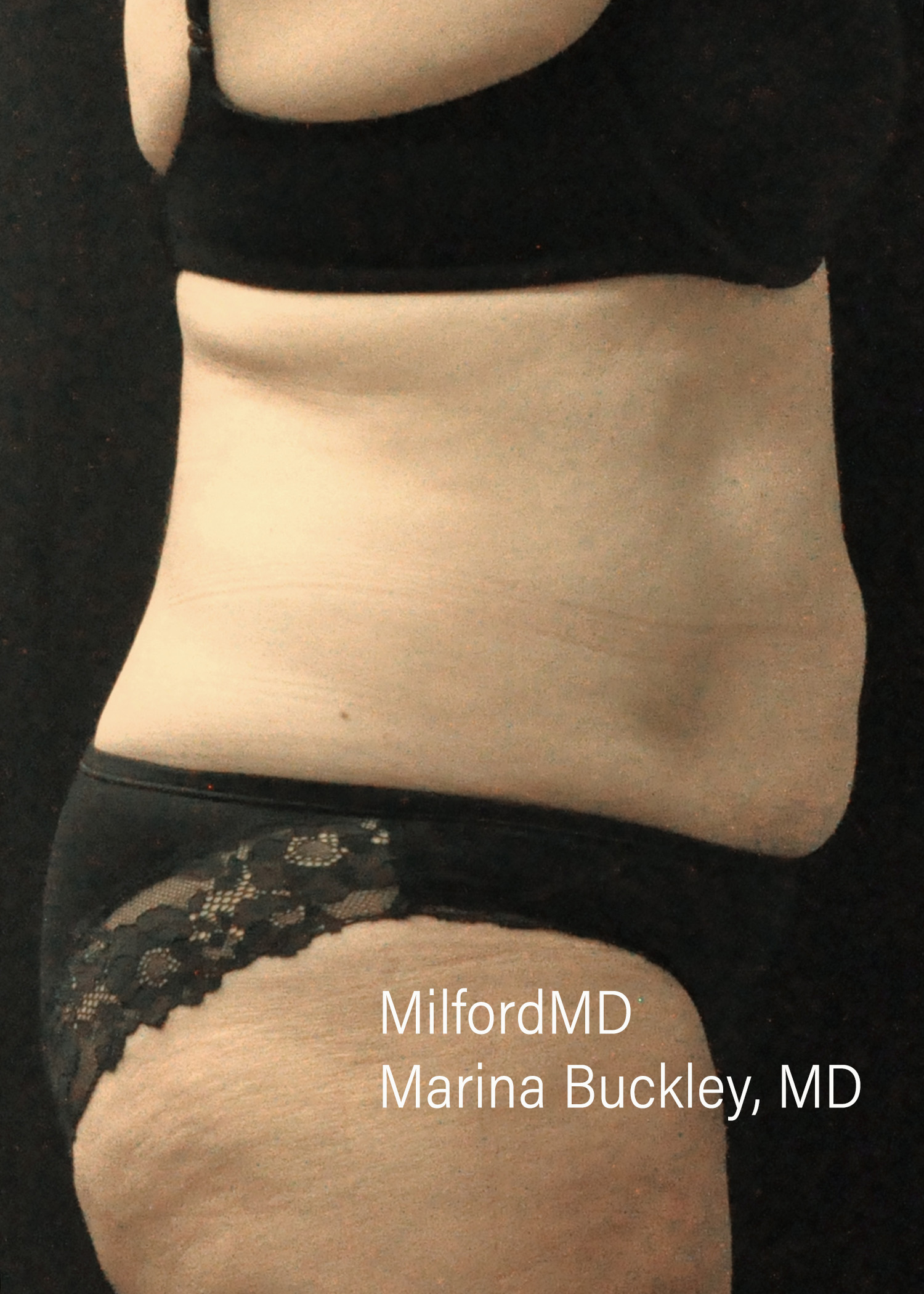 After: CoolSculpting® Body Treatments Using CoolSculpting® Abdomen – Case #36119