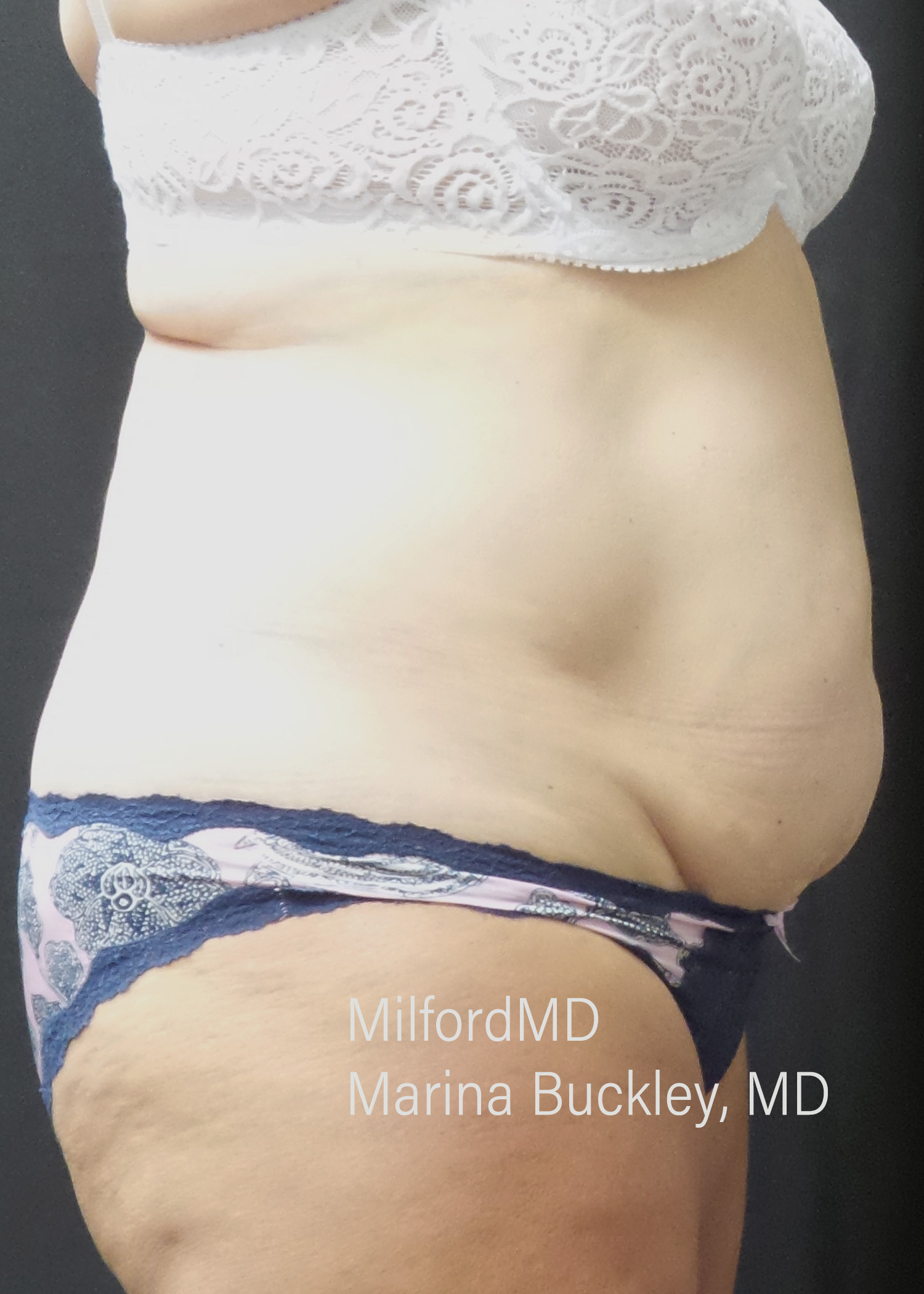 Before: CoolSculpting® Body Treatments Using CoolSculpting® Abdomen – Case #36119