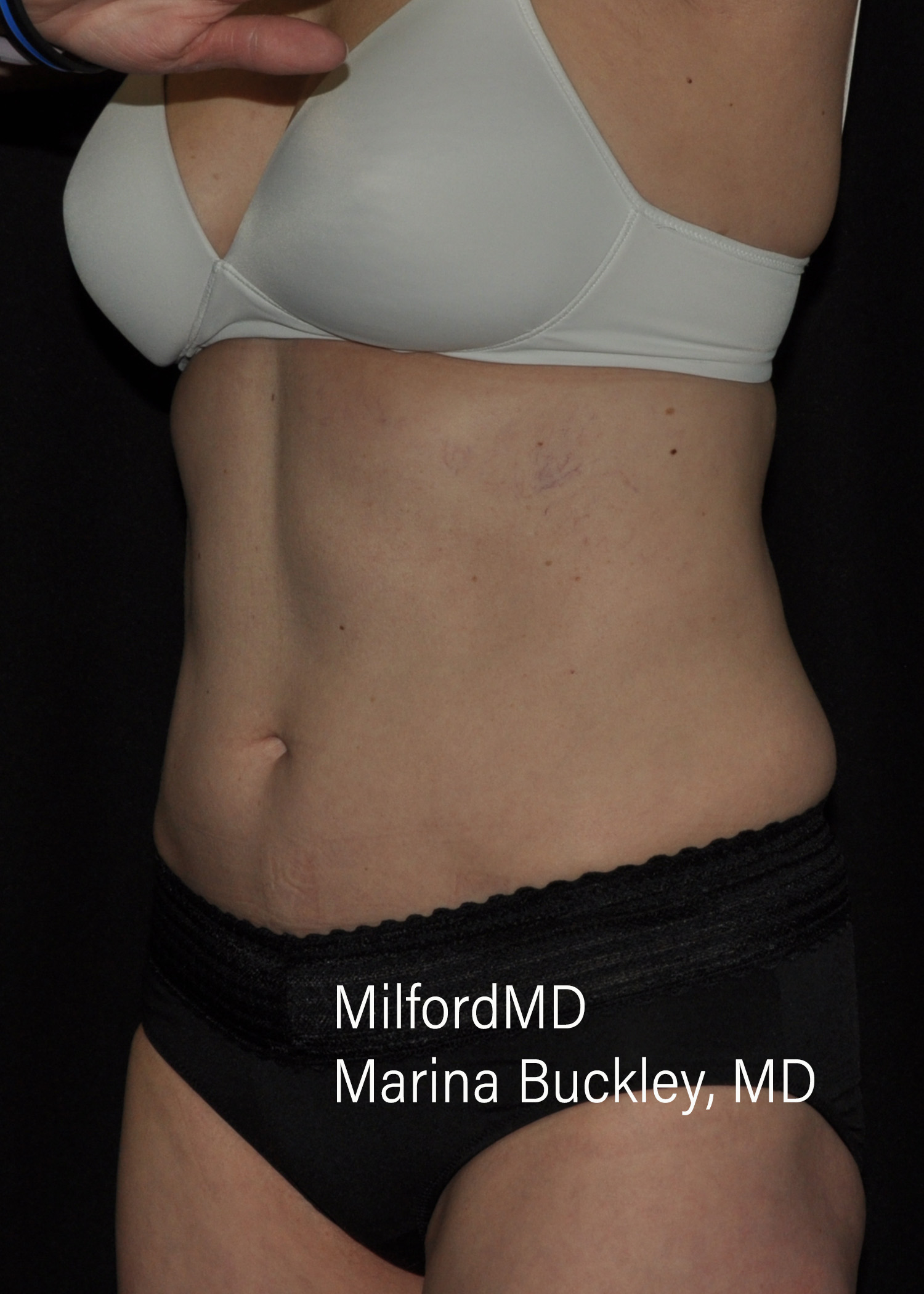 After: CoolSculpting® Body Treatments Using CoolSculpting® Abdomen, Flanks & Love Handles – Case #36118