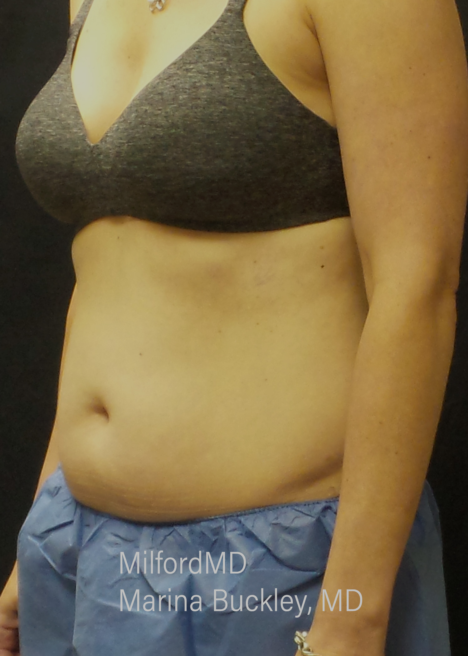 Before: CoolSculpting® Body Treatments Using CoolSculpting® Abdomen, Flanks & Love Handles – Case #36118