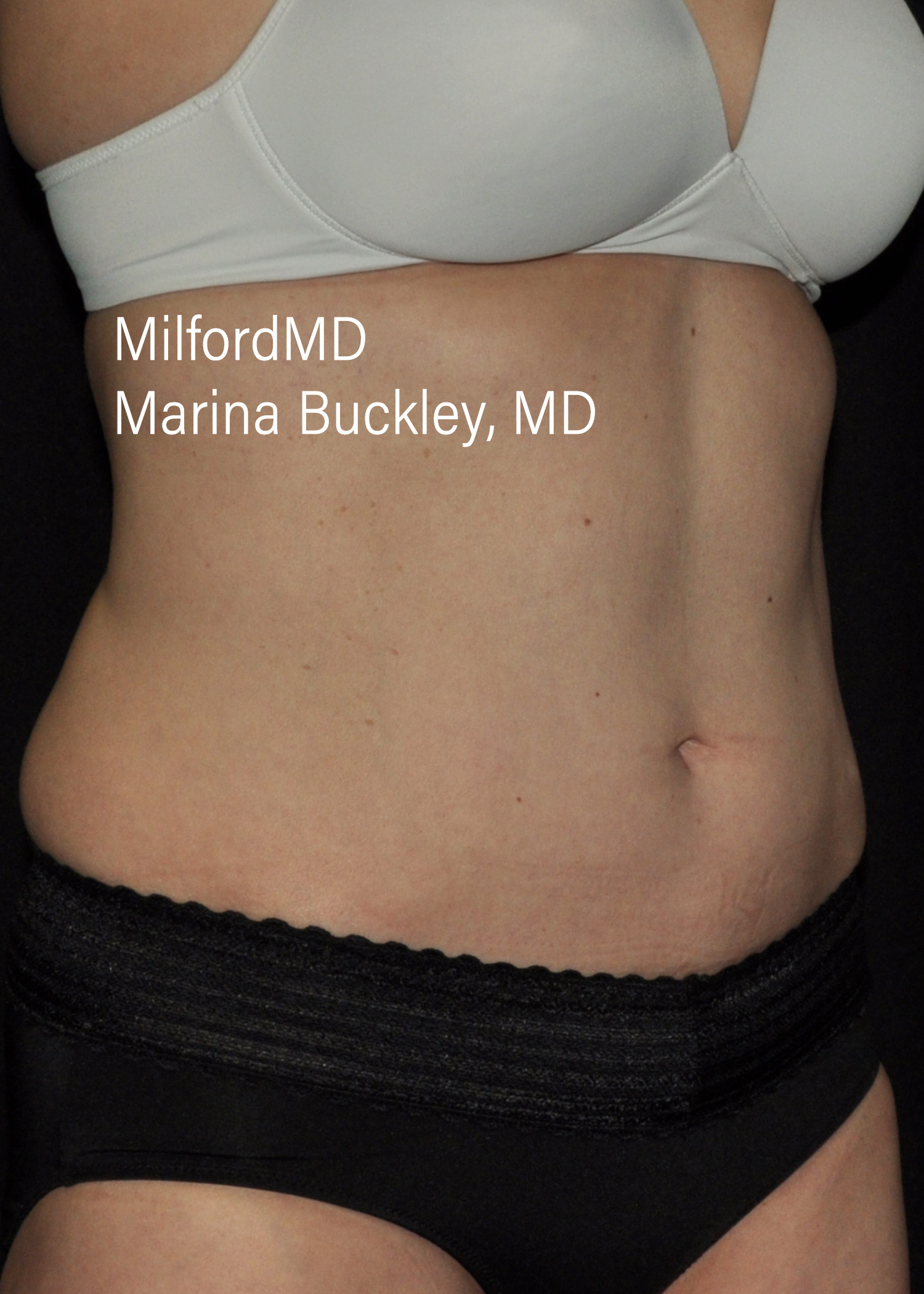 After: CoolSculpting® Body Treatments Using CoolSculpting® Abdomen, Flanks & Love Handles – Case #36118