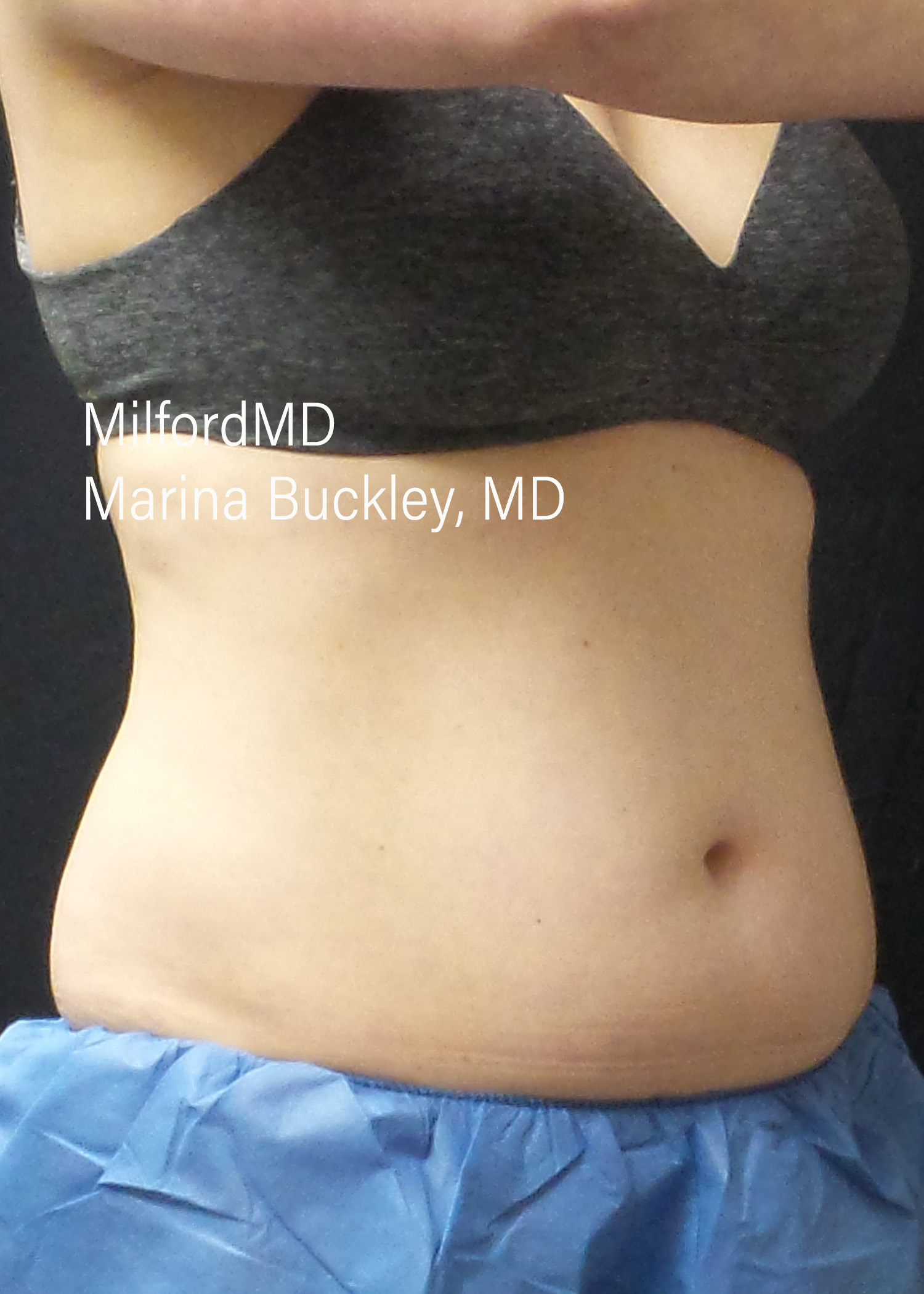 Before: CoolSculpting® Body Treatments Using CoolSculpting® Abdomen, Flanks & Love Handles – Case #36118