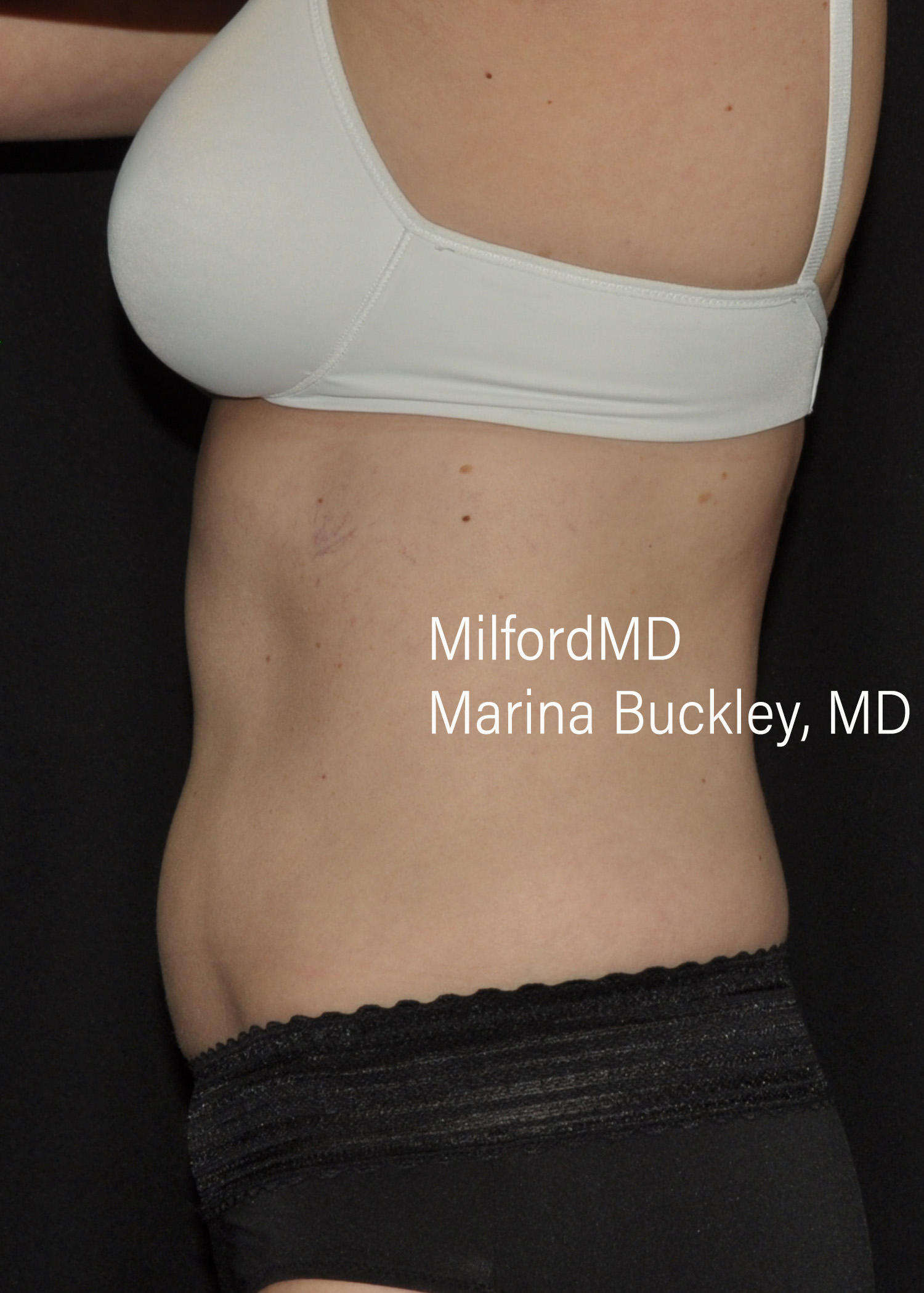 After: CoolSculpting® Body Treatments Using CoolSculpting® Abdomen, Flanks & Love Handles – Case #36118