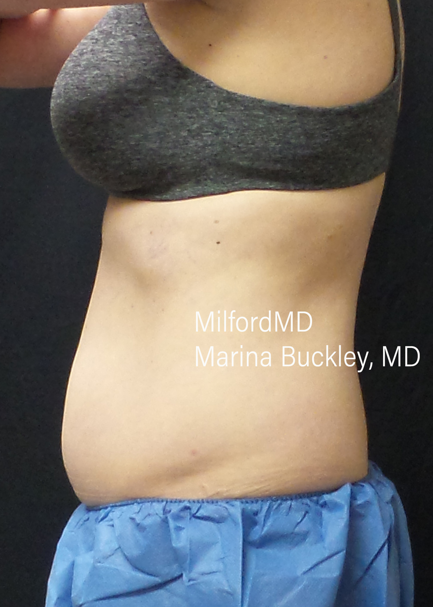 Before: CoolSculpting® Body Treatments Using CoolSculpting® Abdomen, Flanks & Love Handles – Case #36118