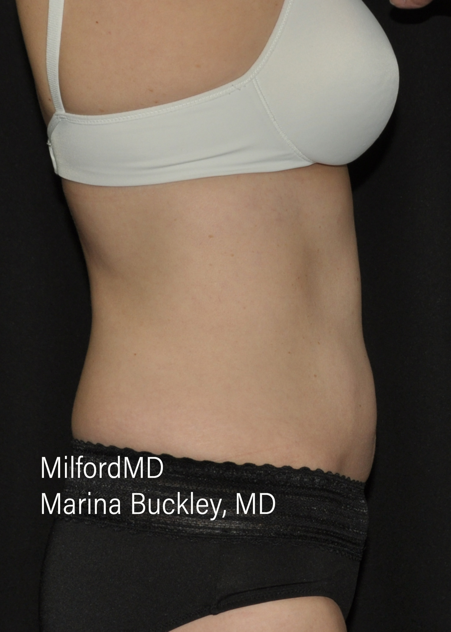 After: CoolSculpting® Body Treatments Using CoolSculpting® Abdomen, Flanks & Love Handles – Case #36118