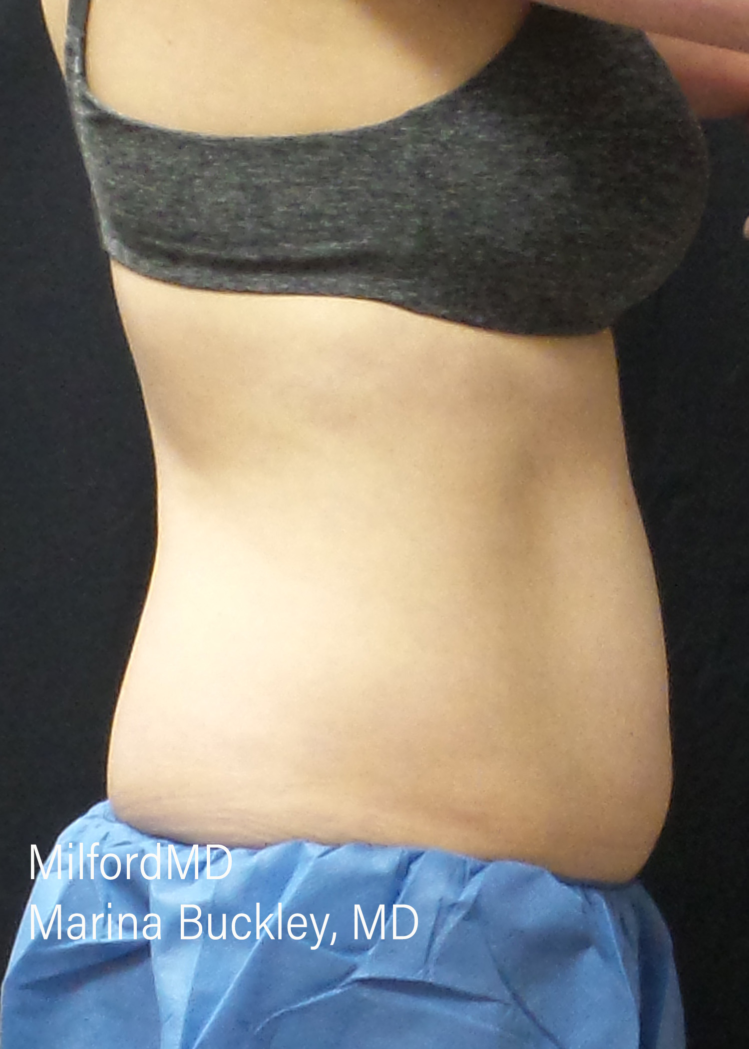 Before: CoolSculpting® Body Treatments Using CoolSculpting® Abdomen, Flanks & Love Handles – Case #36118