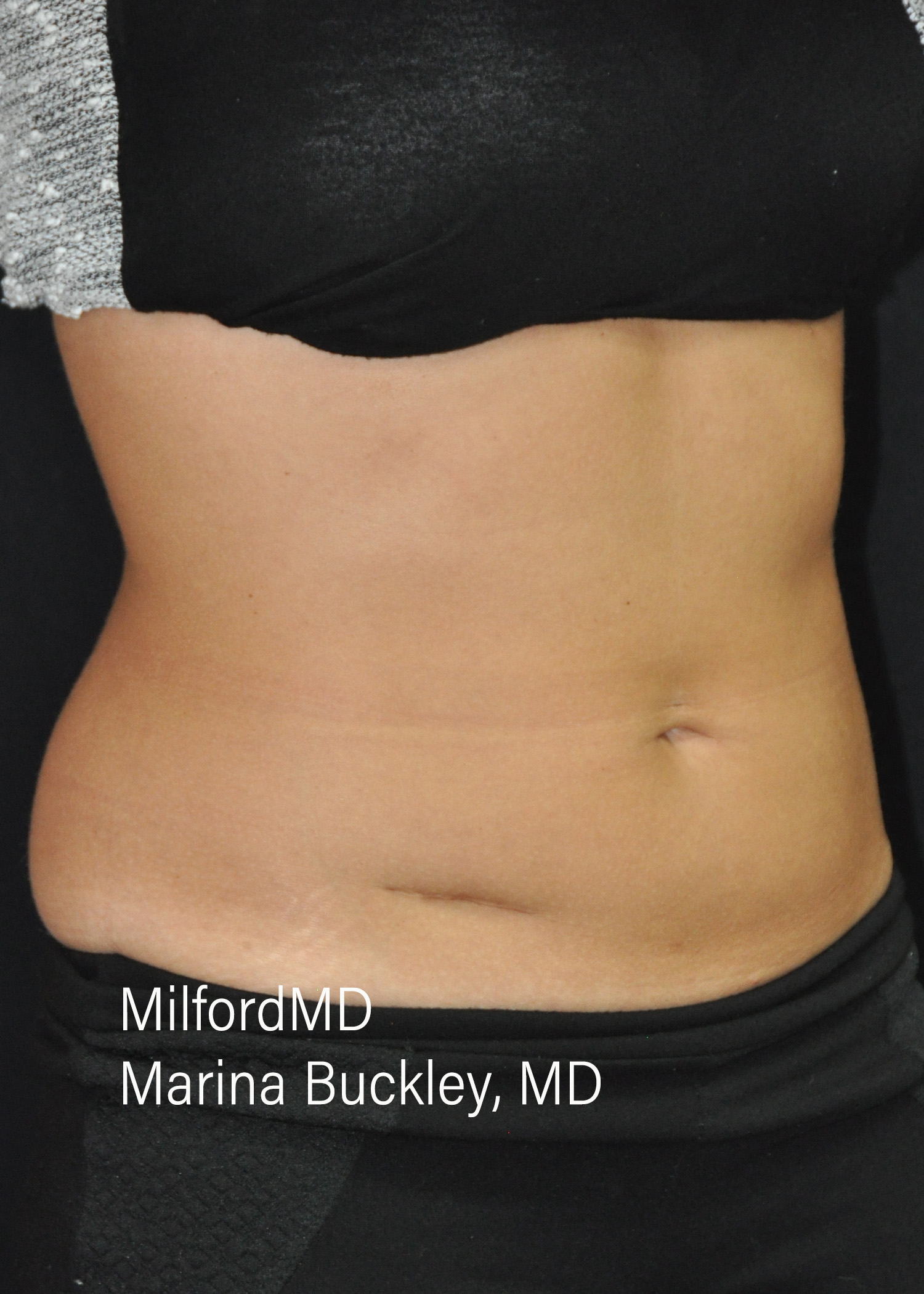 After: CoolSculpting® Body Treatments Using CoolSculpting® Love Handles – Case #36120