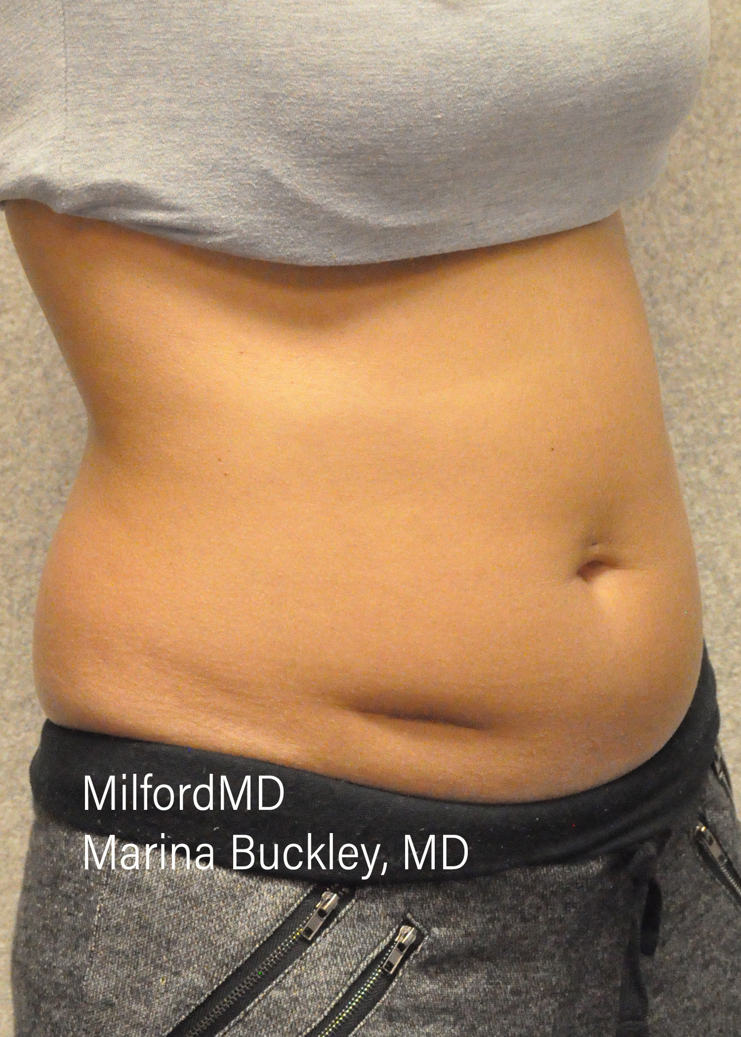 Before: CoolSculpting® Body Treatments Using CoolSculpting® Love Handles – Case #36120