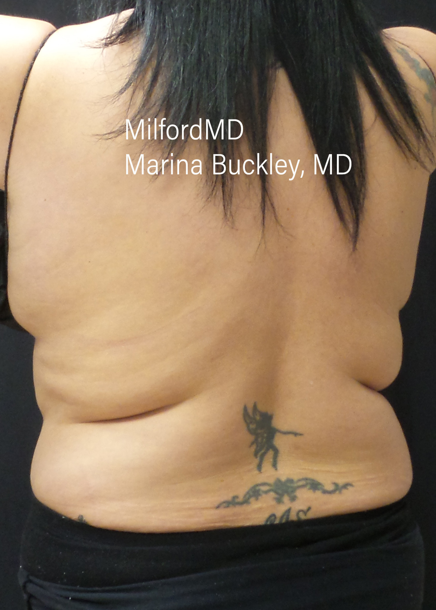 Before: CoolSculpting® Love Handles – Case #36123