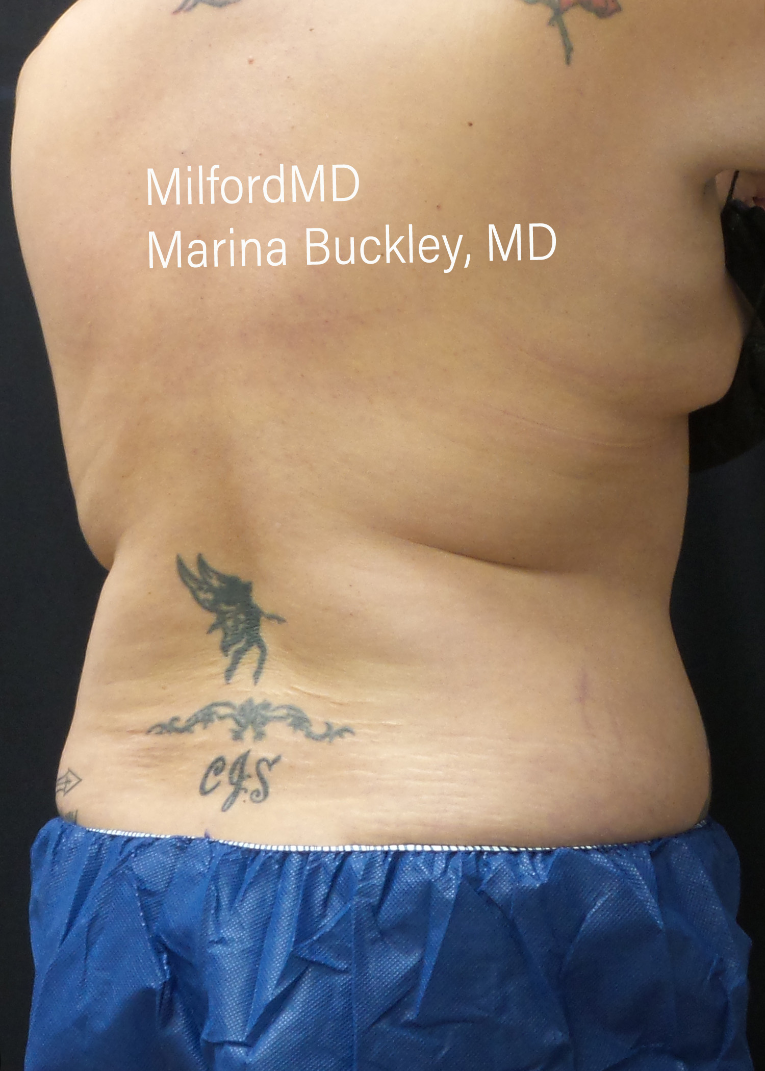 After: CoolSculpting® Love Handles – Case #36123