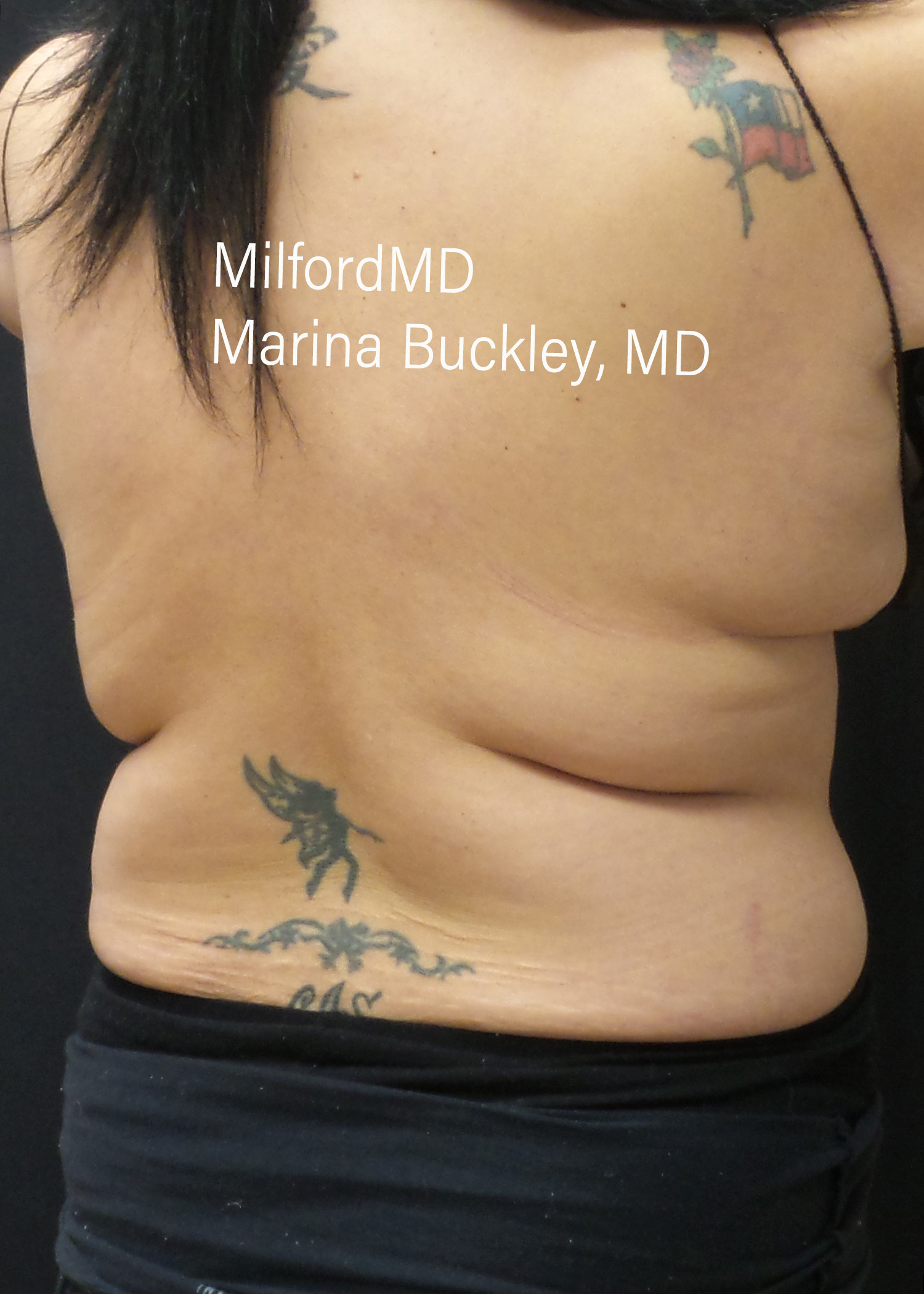 Before: CoolSculpting® Love Handles – Case #36123