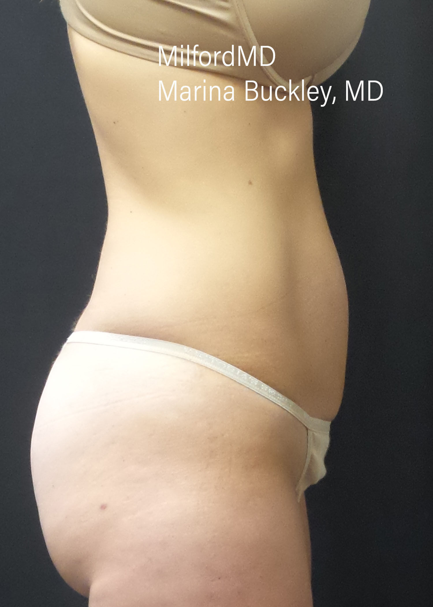 After: CoolSculpting® Love Handles – Case #36124